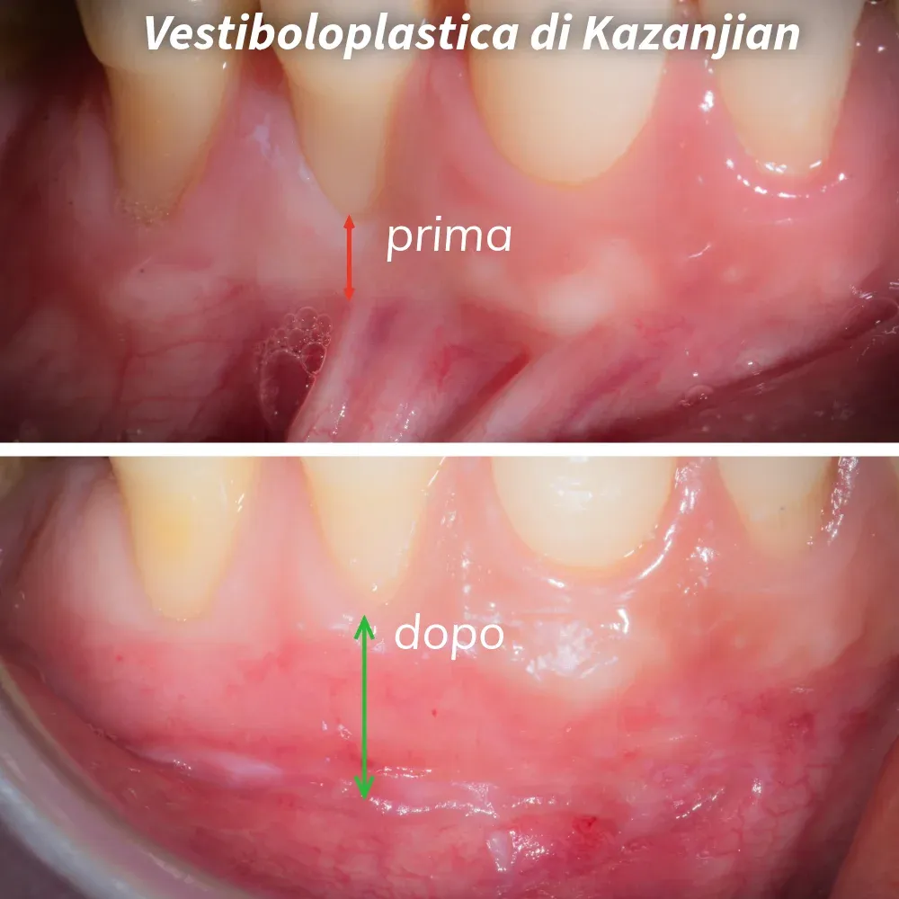 Vestiboloplastica di Kazanjian: prima e dopo. In alto la situazione preoperatoria con vestibolo ridotto, in basso il risultato postoperatorio con aumento della profondità vestibolare e della gengiva aderente.