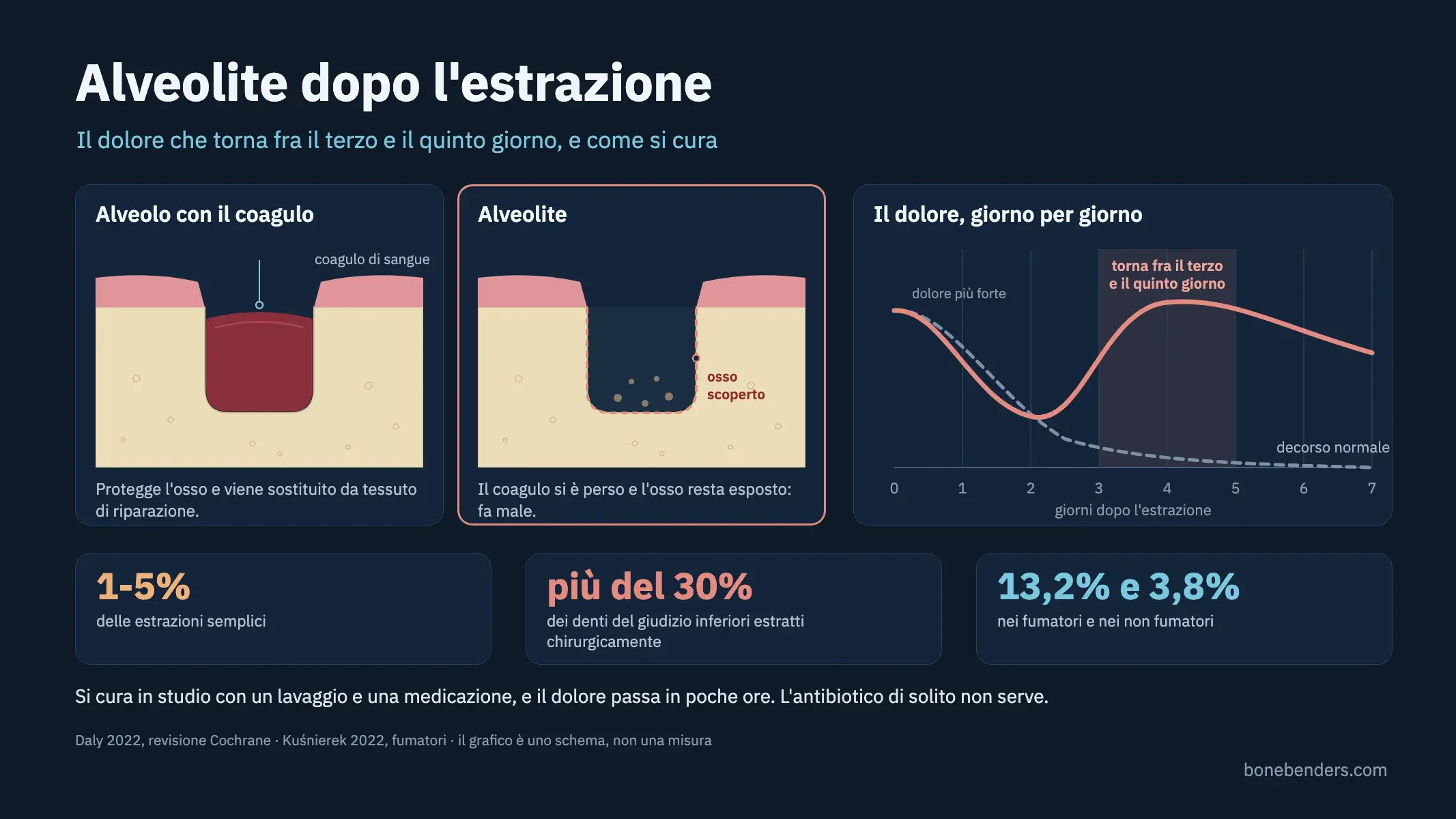 Schema di un alveolo dopo l'estrazione: a sinistra il coagulo che protegge l'osso, a destra l'alveolo vuoto dell'alveolite, con la curva del dolore che risale al terzo-quinto giorno