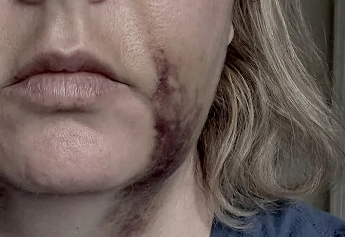 edema ecchimosi da gbr