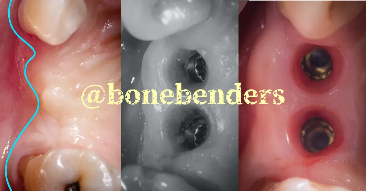 100% Osso 100% Cheratinizzata Sempre