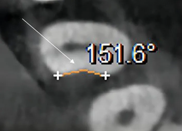 Angolo della concavità mesiale misurato alla sezione assiale CBCT: 151,6° in un primo premolare mascellare. Immagine: Chen et al., 2024, Scientific Reports — CC-BY 4.0