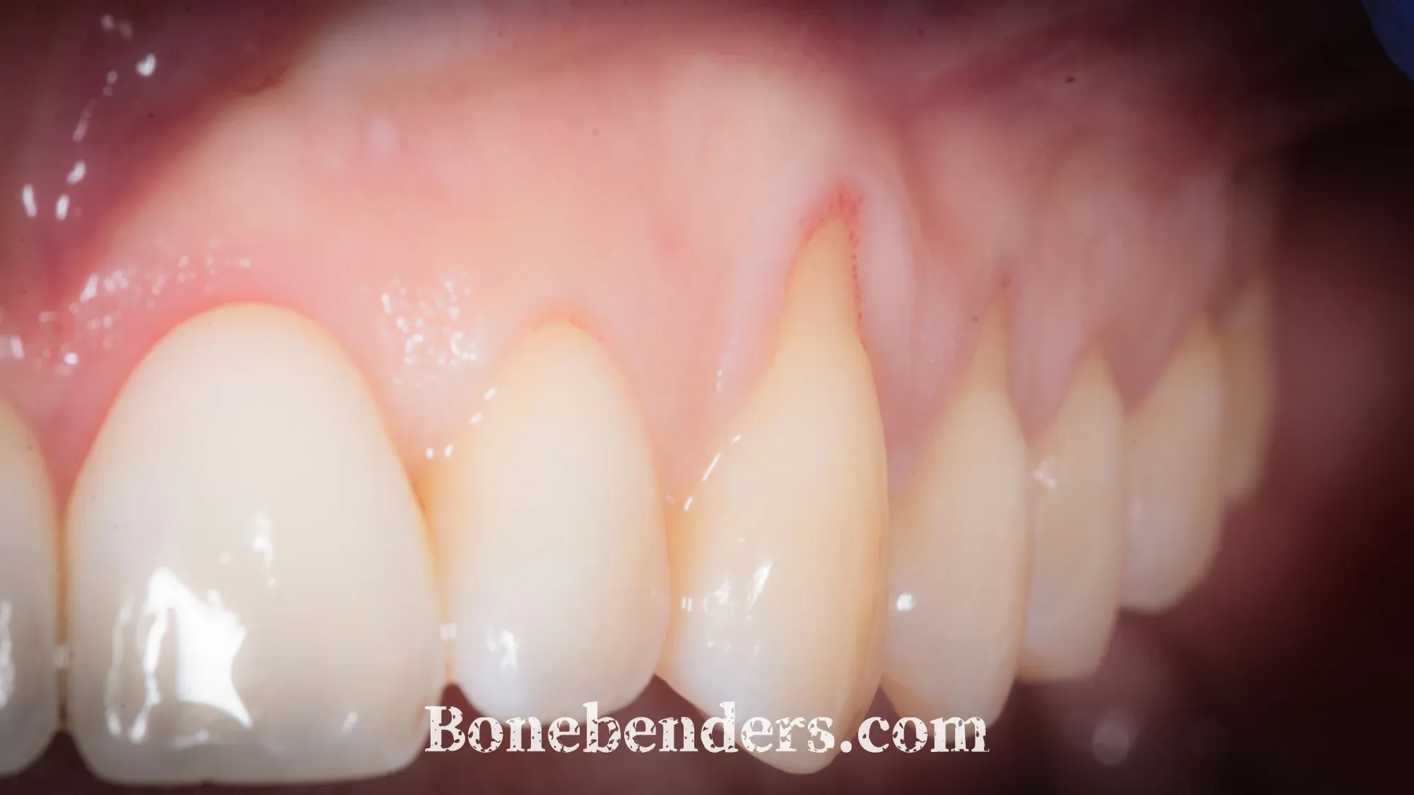 Recessioni gengivali vestibolari sul canino e sui premolari superiori sinistri, con la recessione più profonda sul canino 2.3 e la radice scoperta — fotografia intraorale pre-operatoria