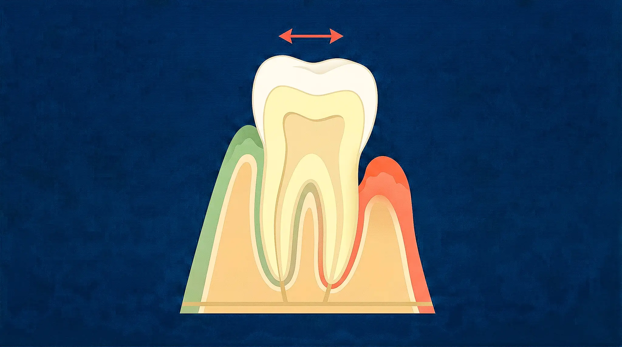 Rappresentazione della mobilità dentale con osso alveolare compromesso