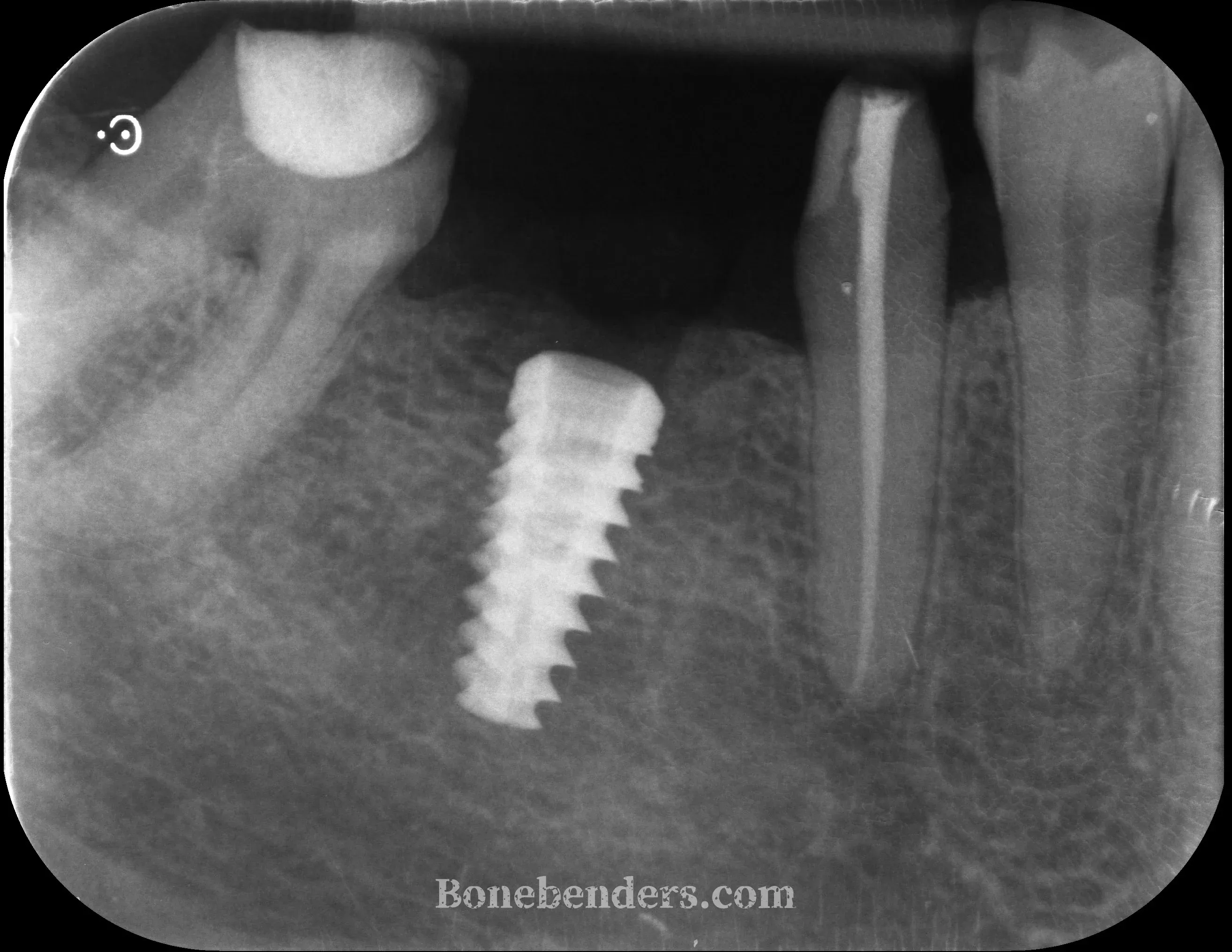Post-operative periapical radiograph showing the implant correctly placed at site 4.6 after osteo-mucosal expansion, without grafts or membranes