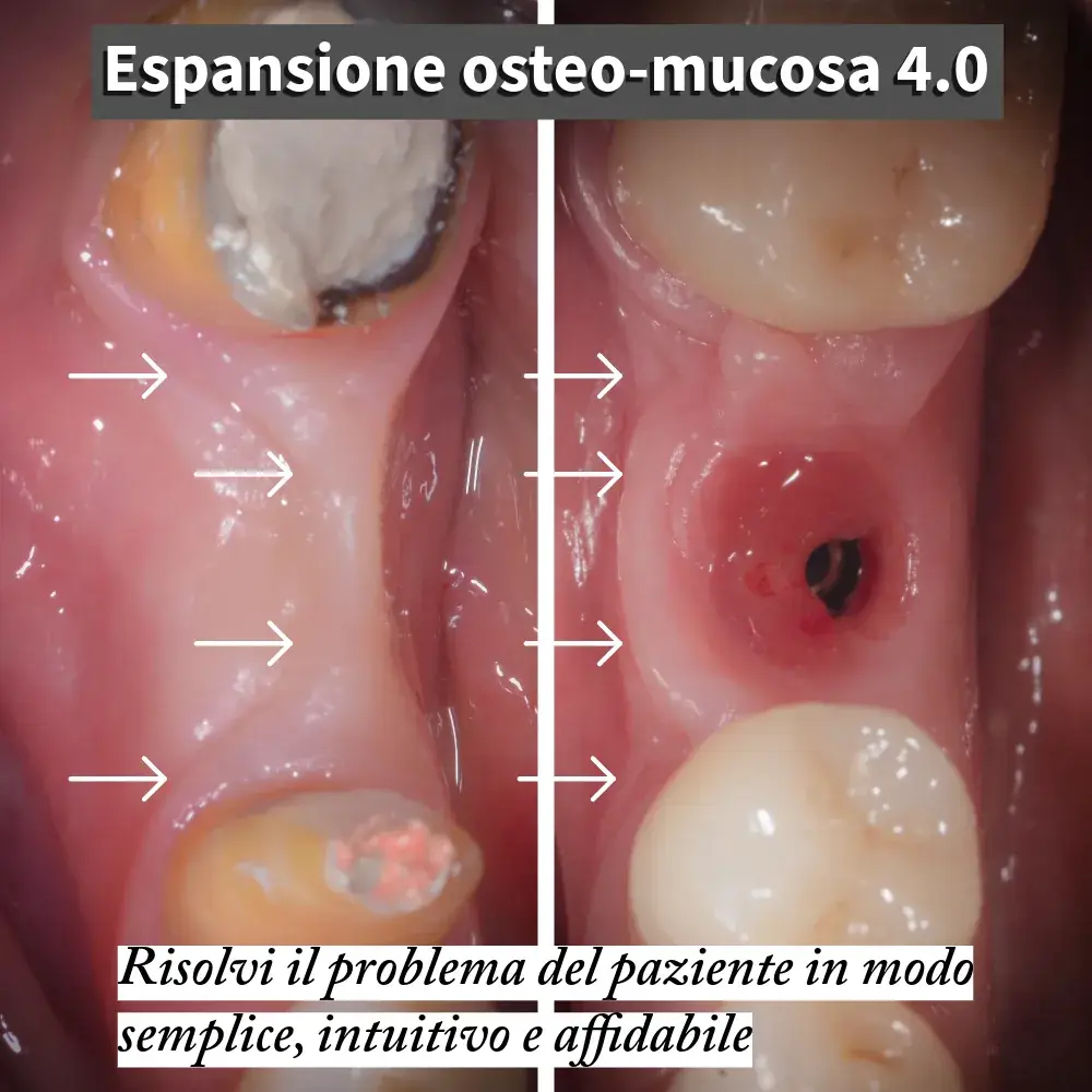 Mandibular site at 4.6 with severe osteo-mucosal defect, concave ridge and almost absent keratinised mucosa (arrows mark the defect boundaries) — pre-operative clinical situation.