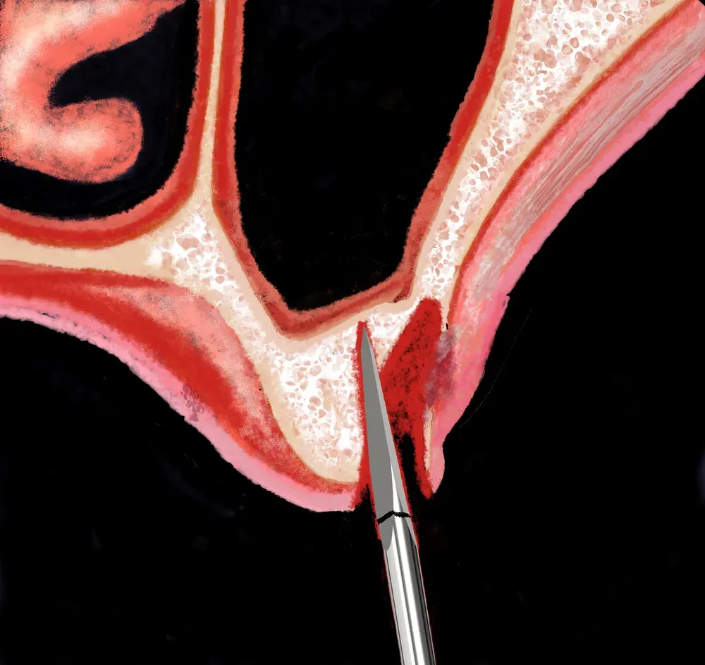 Illustrazione che mostra una fresa lanceolata in prossimità del seno mascellare, evidenziando l