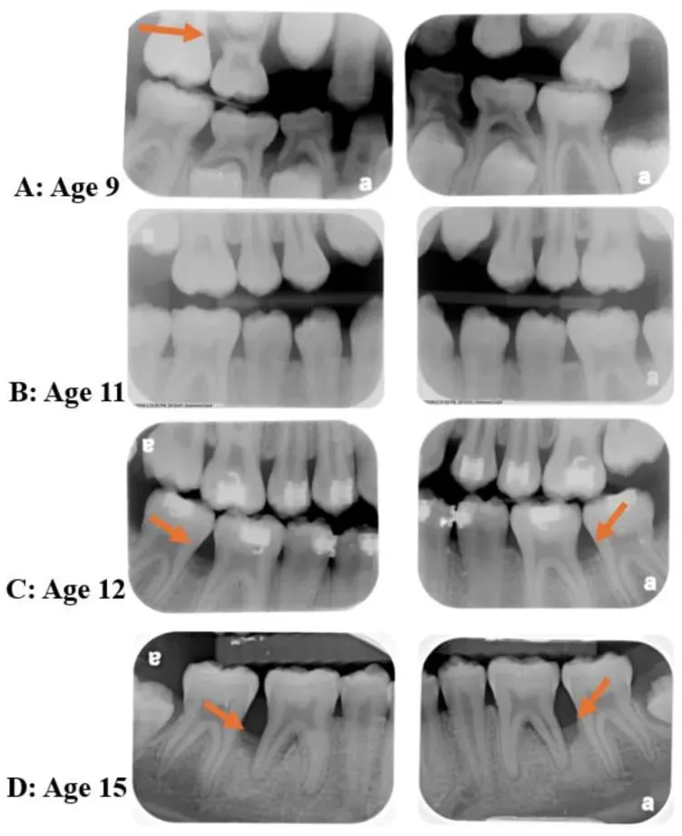 Juvenile periodontitis clinical case