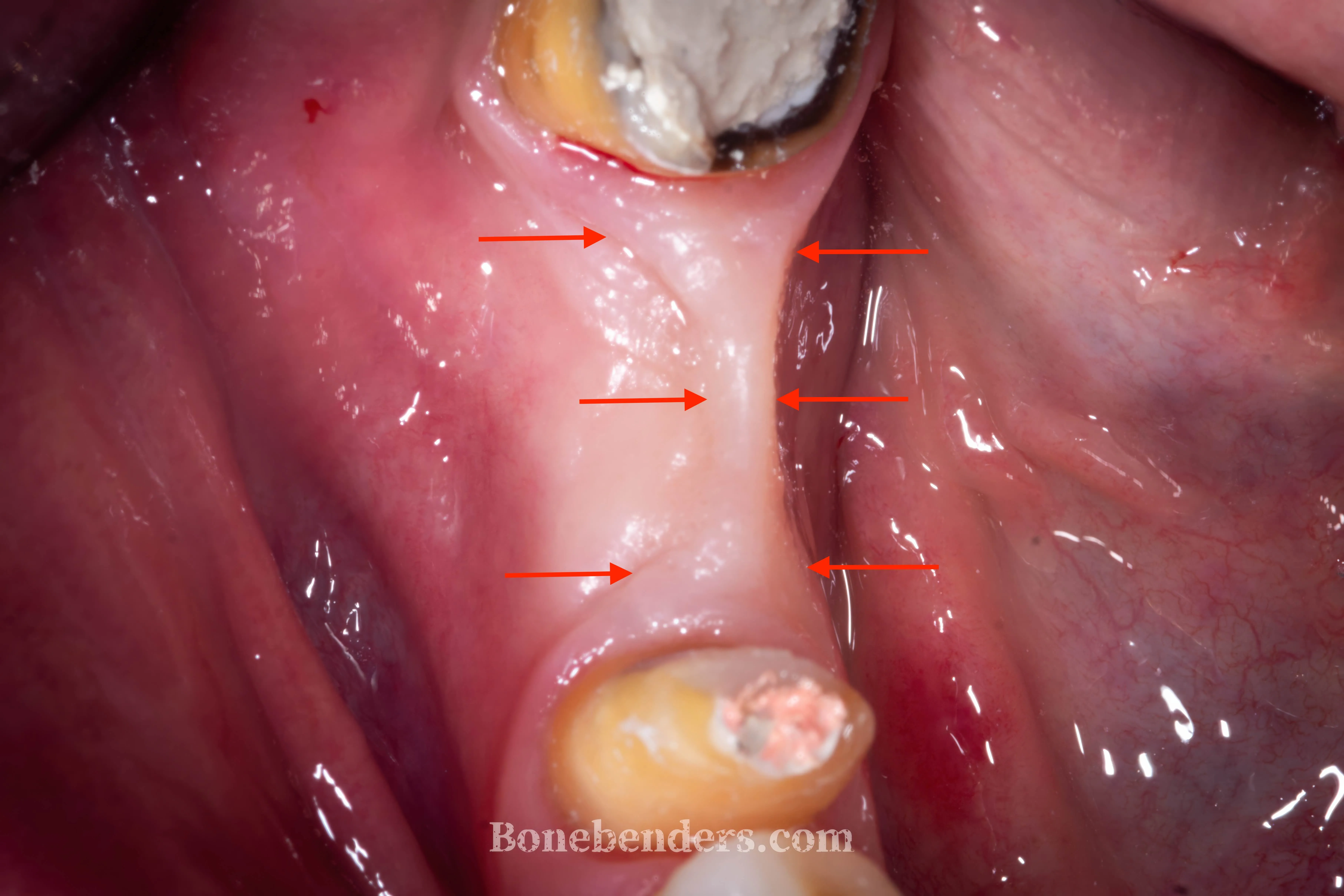 Immagine preoperatoria prima di espansione osteomucosa ERE