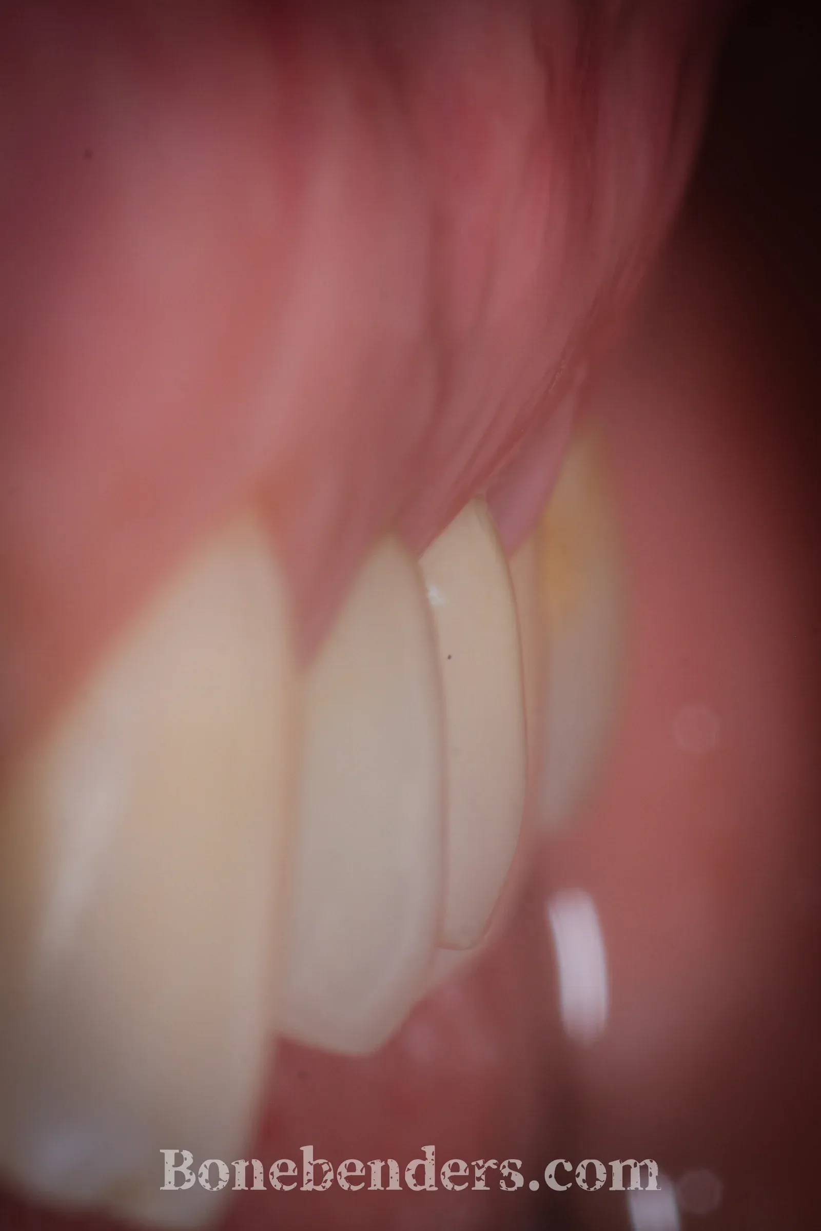 Corona in ceramica definitiva su impianto in zona 2.5 — risultato clinico finale