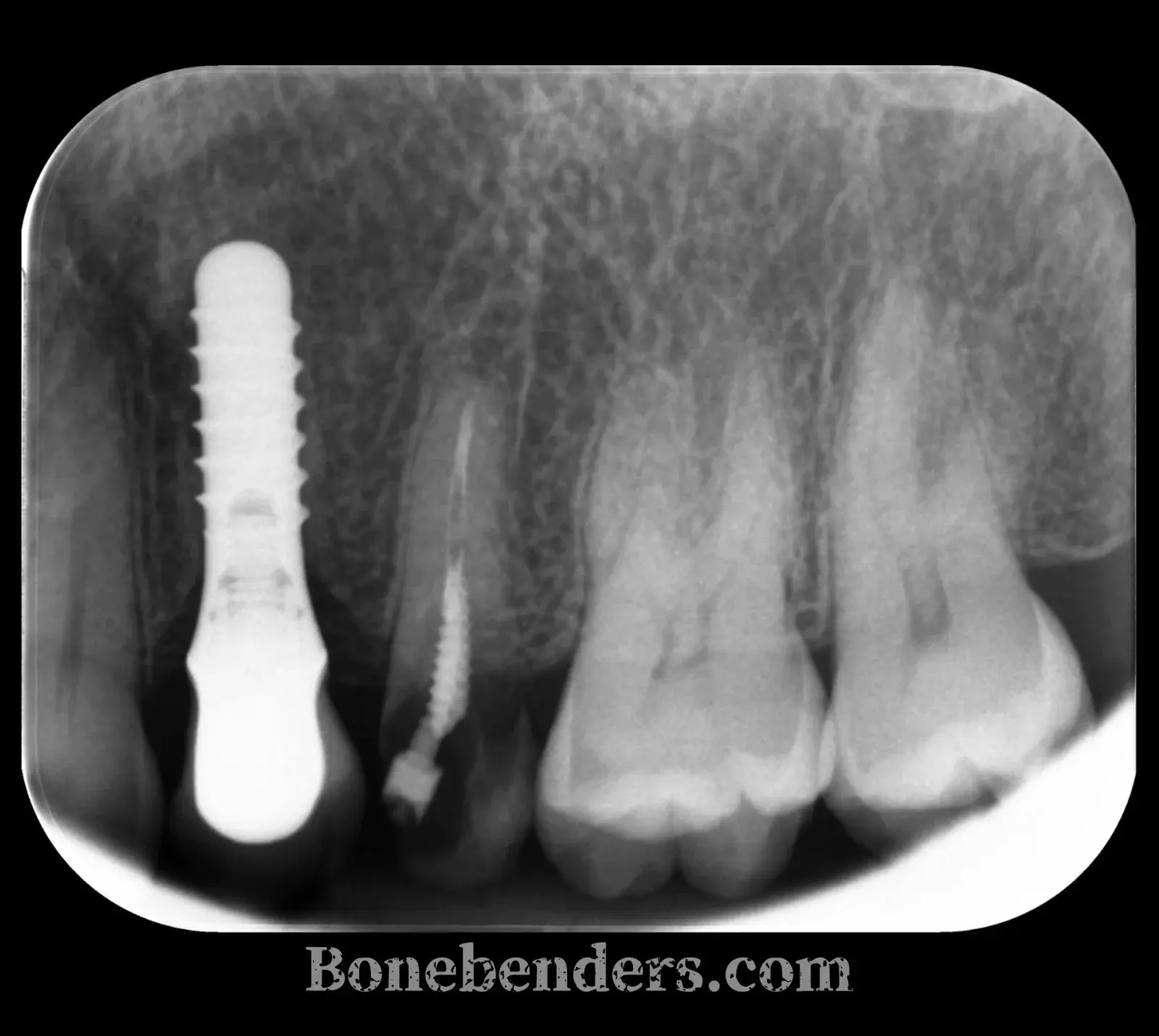 Radiografia periapicale pre-operatoria — impianto post-estrattivo in zona 2.5 a carico immediato