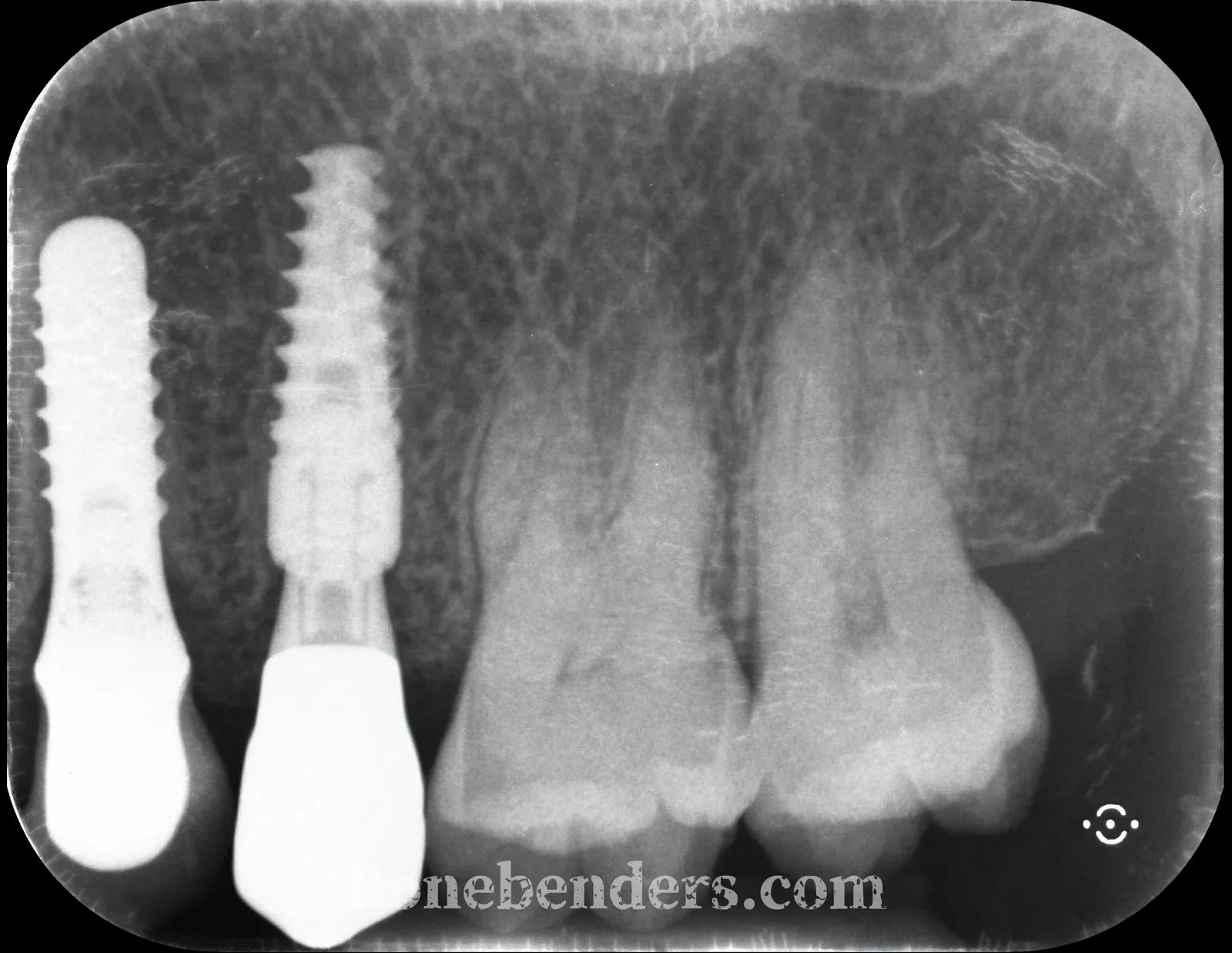 Radiografia periapicale di controllo a 3 mesi — osteointegrazione dell'impianto in zona 2.5