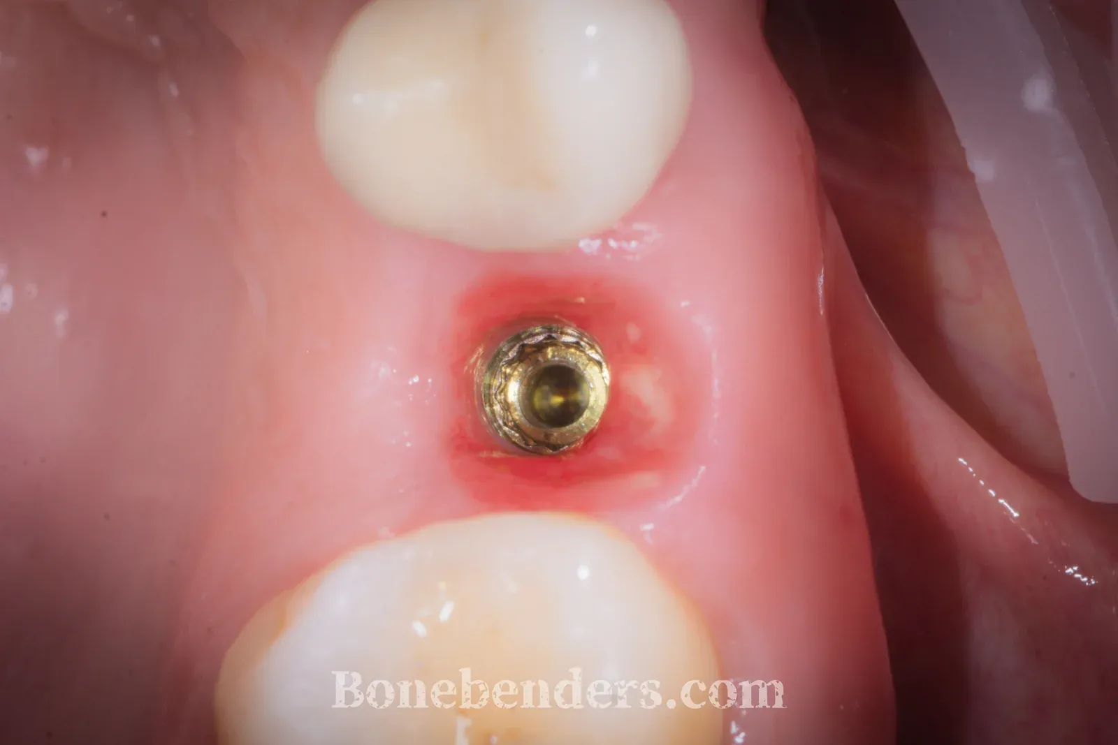 Vite di guarigione in situ, tessuti molli periimplantari sani a 3 mesi, prima del posizionamento della corona