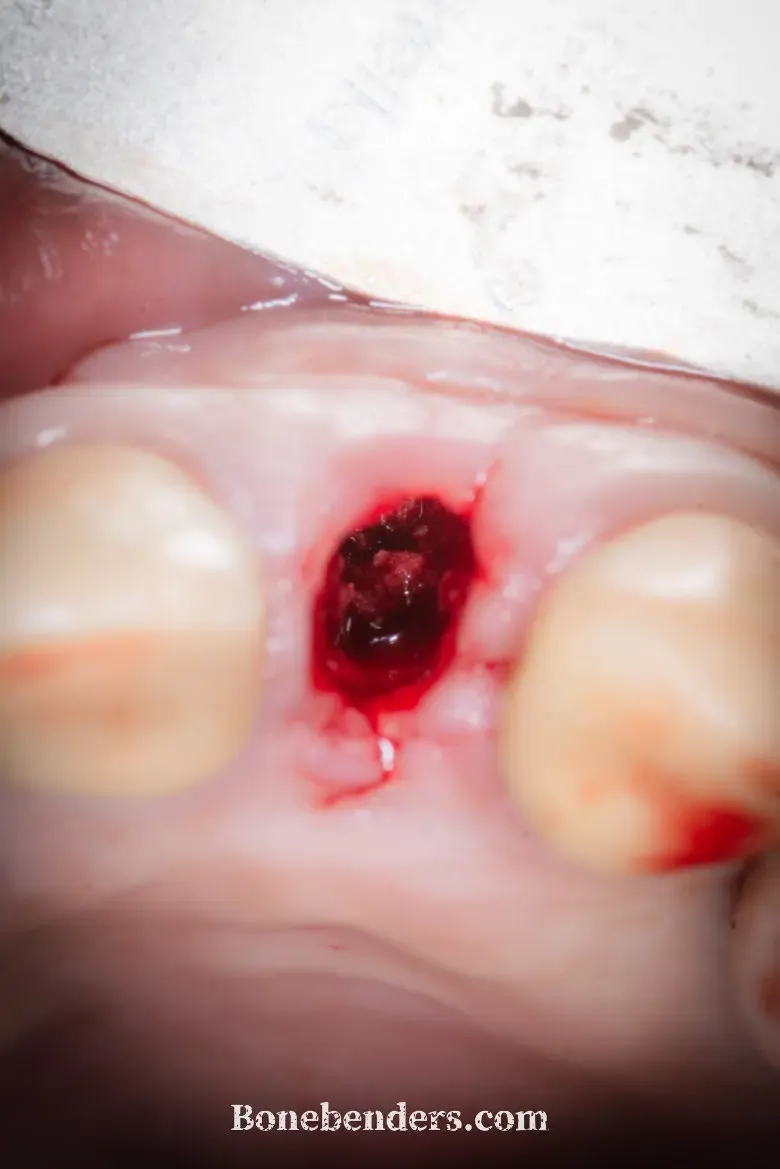 Visione occlusale del sito 22 prima dell'inserimento dell'impianto: la nuova osteotomia, preparata con gli espansori, è sul versante palatale e separata dall'alveolo