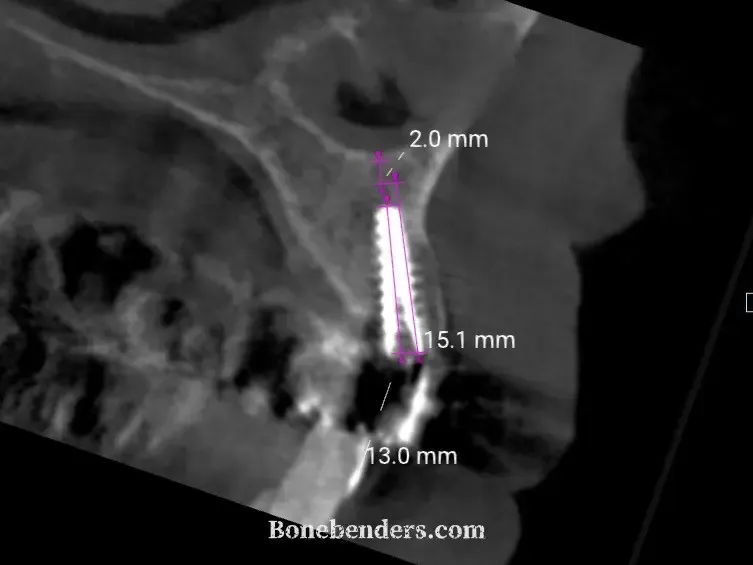 Ricostruzione sagittale della CBCT intraoperatoria con l'espansore da 13 mm in sede: 2,0 mm di osso residuo fino al pavimento nasale e 15,1 mm di profondità lungo l'asse