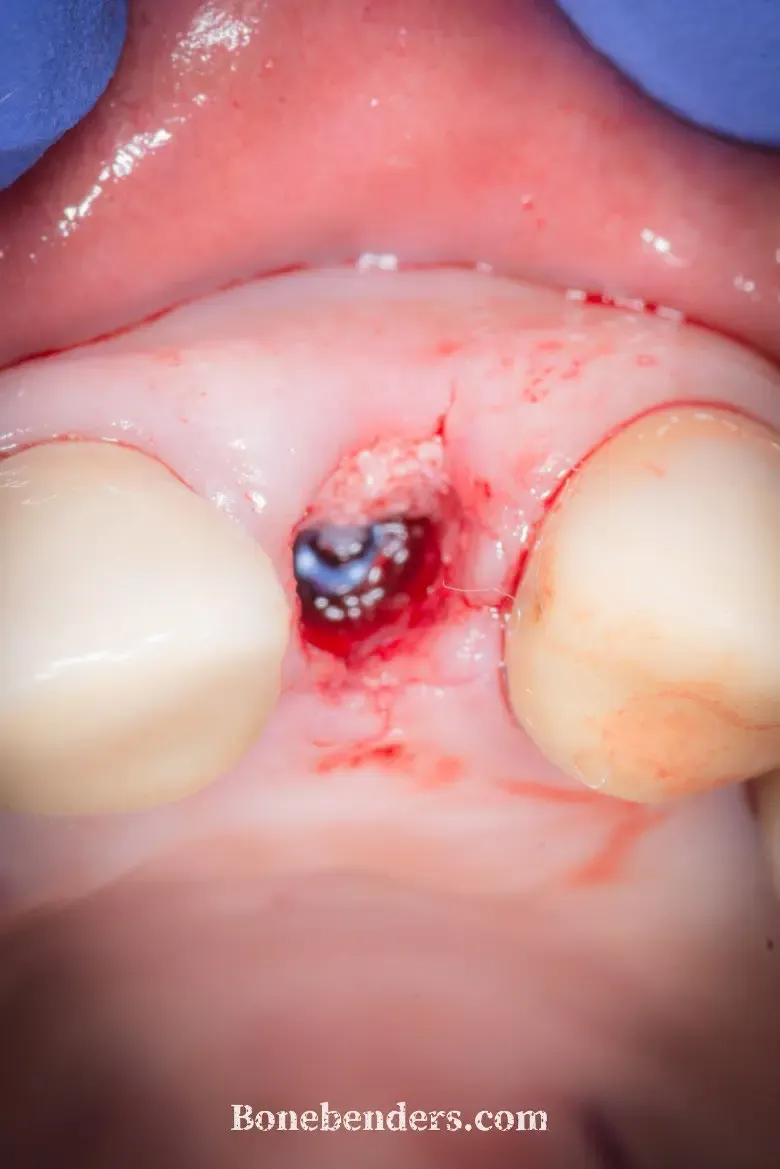 Visione occlusale dopo l'inserimento: il gap tra impianto e parete vestibolare è riempito di xenoinnesto bovino deproteinizzato