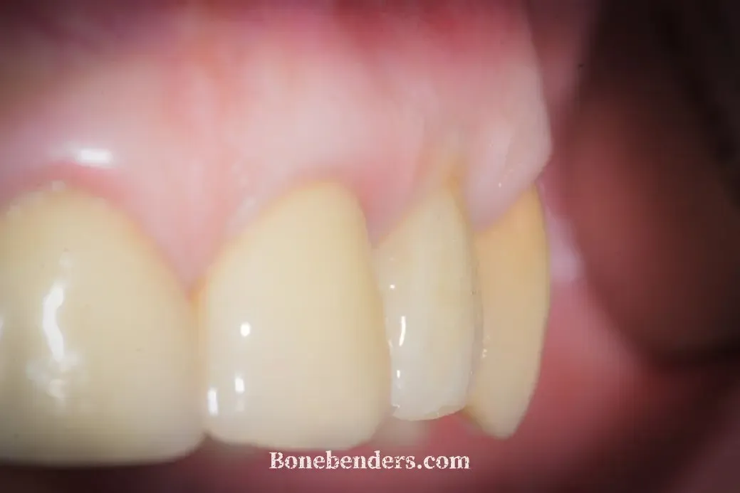 Visione laterale il giorno della consegna della corona definitiva in zirconia sul 22: margine vestibolare allineato, profilo convesso, papille presenti
