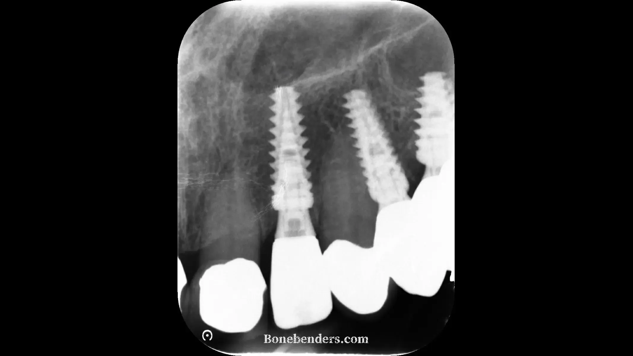 Radiografia endorale del controllo dopo la consegna della corona definitiva in zirconia sul 22: impianto in posizione palatale e profonda, apice sulla corticale del pavimento nasale, livello osseo marginale stabile.