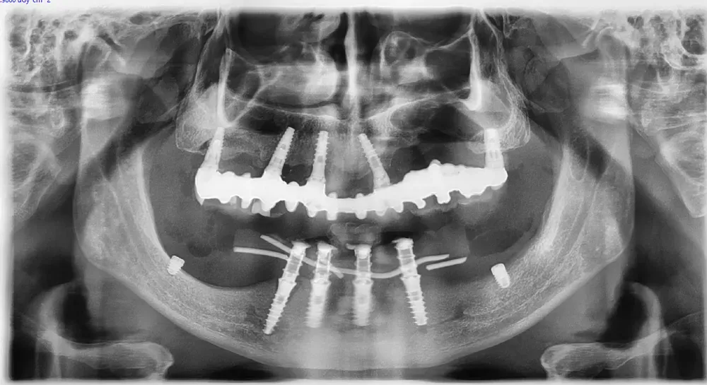 carico immediato inferiore con impiANTI SHORT posteriori