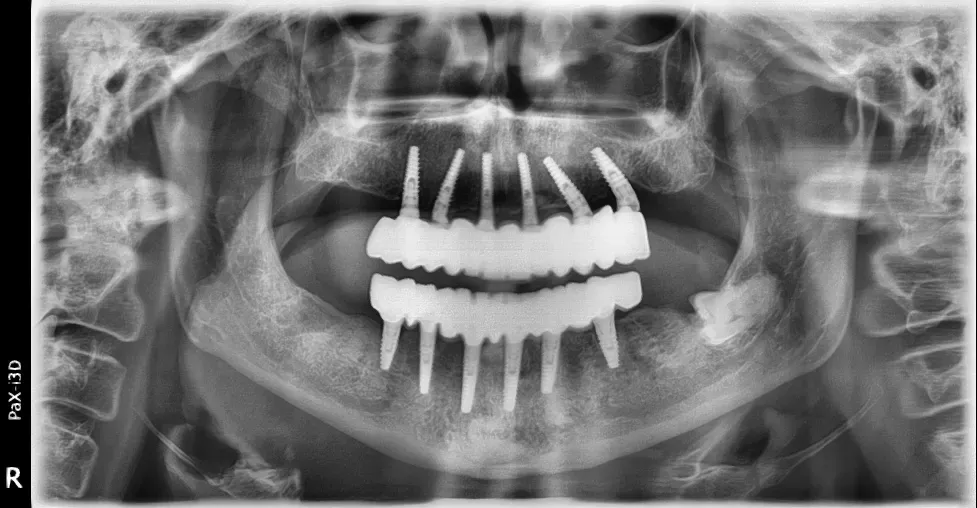 all on six e zirconia