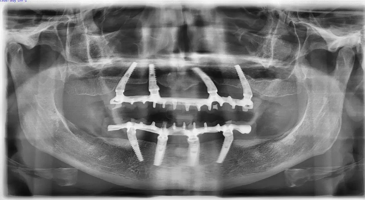 Carico Immediato: Tecnica, Vantaggi e Quando è Indicato