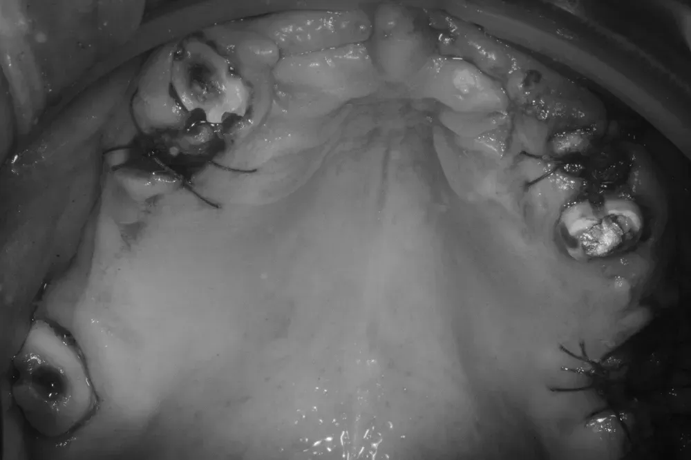 Arcata superiore edentula