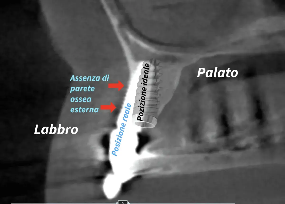Malpositioned Dental Implant: Risks, Symptoms and Solutions
