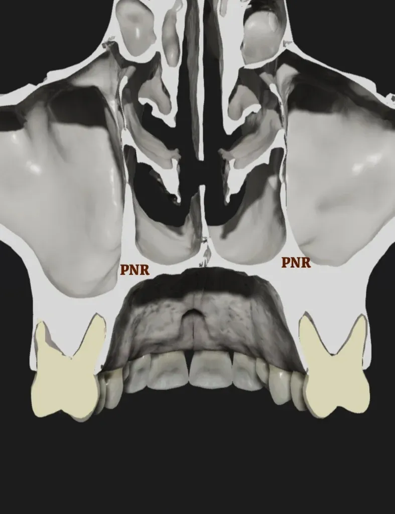 Sezione sagittale del mascellare superiore con etichetta PNR: recesso naso-palatino all'angolo tra pavimento sinusale medial e parete laterale della cavità nasale