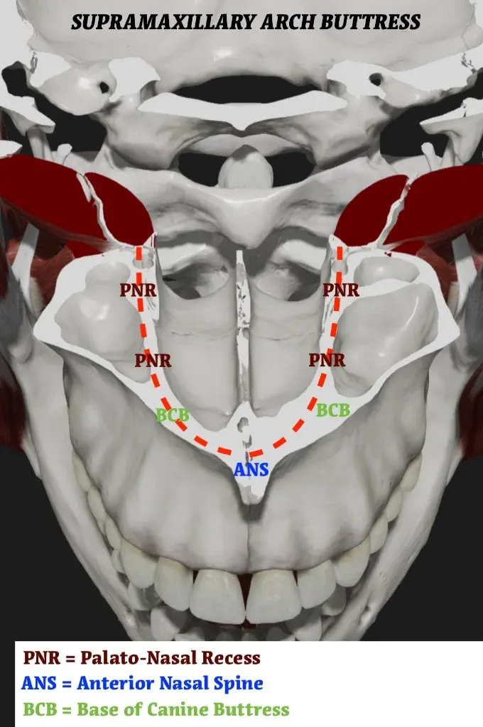 Axial section of the upper jaw: supramaxillary arch with PNR, base of canine buttress (BCB), and anterior nasal spine (ANS)