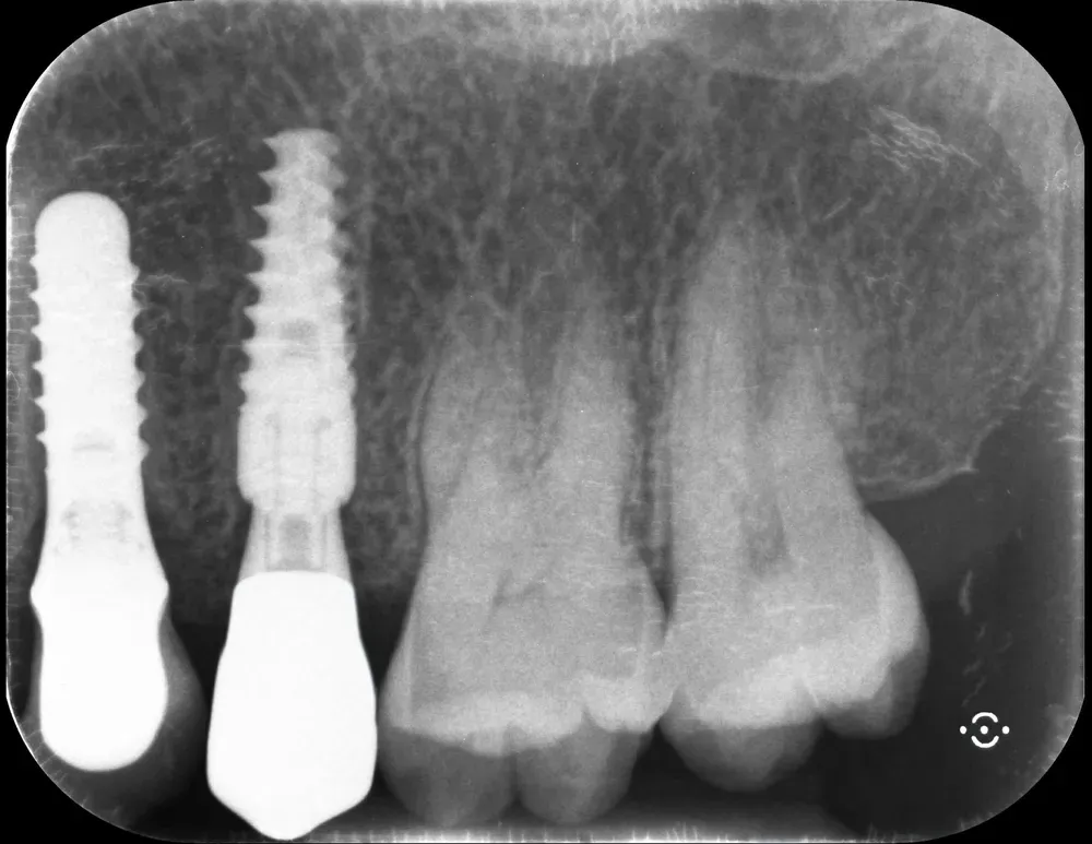 Un impianto (più vecchio) tissue-level a sinistra affiancato da un nuovo impianto infracrestale a connessione conica. Notare l