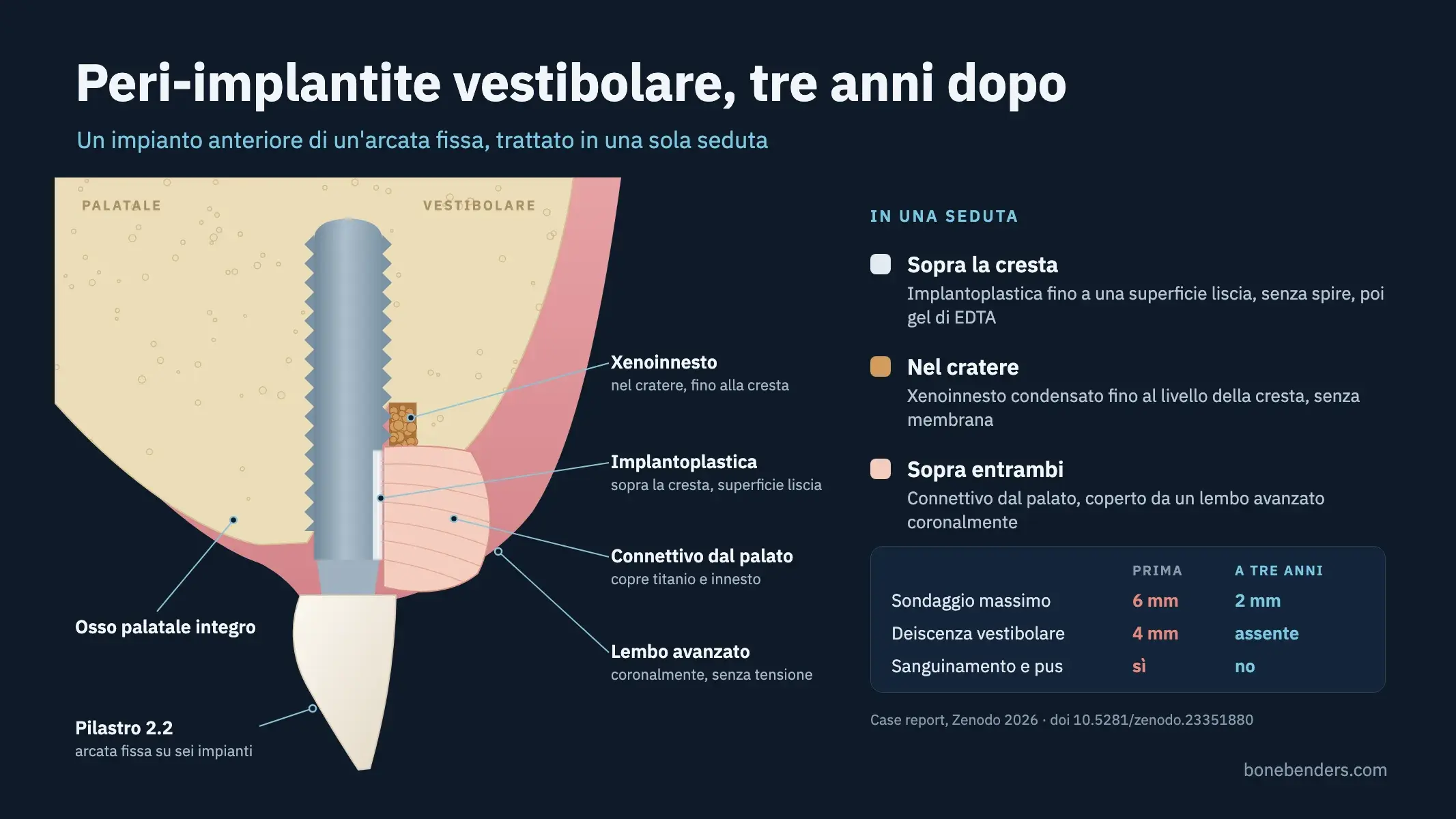 Cross-section diagram of a treated peri-implantitis site, with the smoothed buccal implant surface, xenograft particles in the intrabony defect, and a connective tissue graft covering the titanium.
