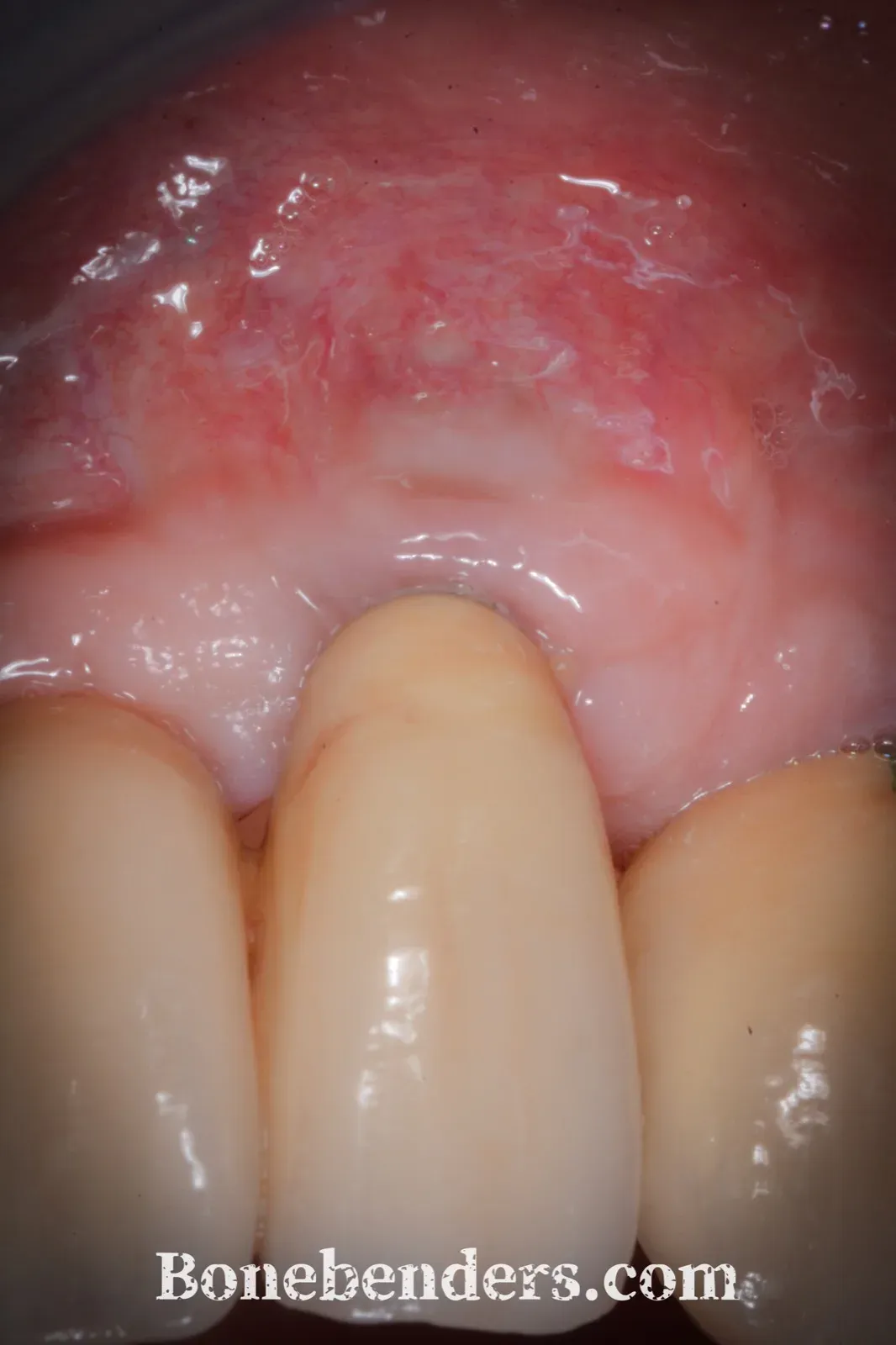 Aspetto clinico a 3 anni: mucosa peri-implantare spessa, cheratinizzata, senza deiscenza e senza superficie implantare visibile