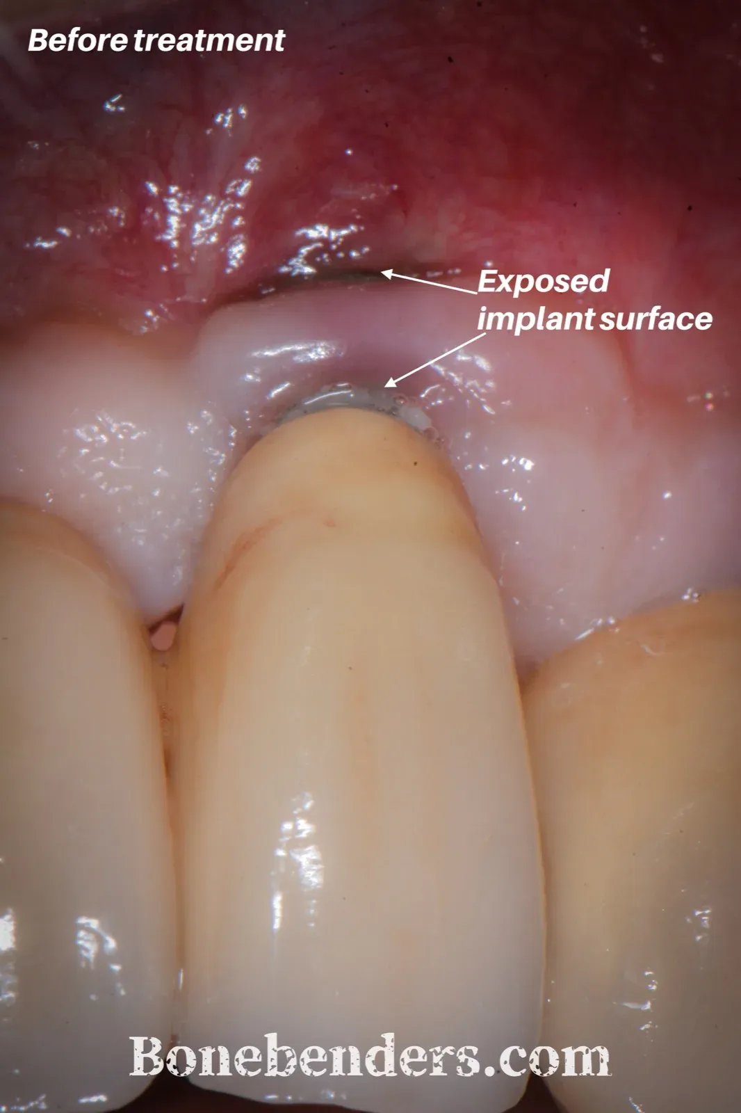 Situazione pre-operatoria: mucosa peri-implantare eritematosa con deiscenza vestibolare che espone il collare levigato e la parte coronale della superficie ruvida dell'impianto