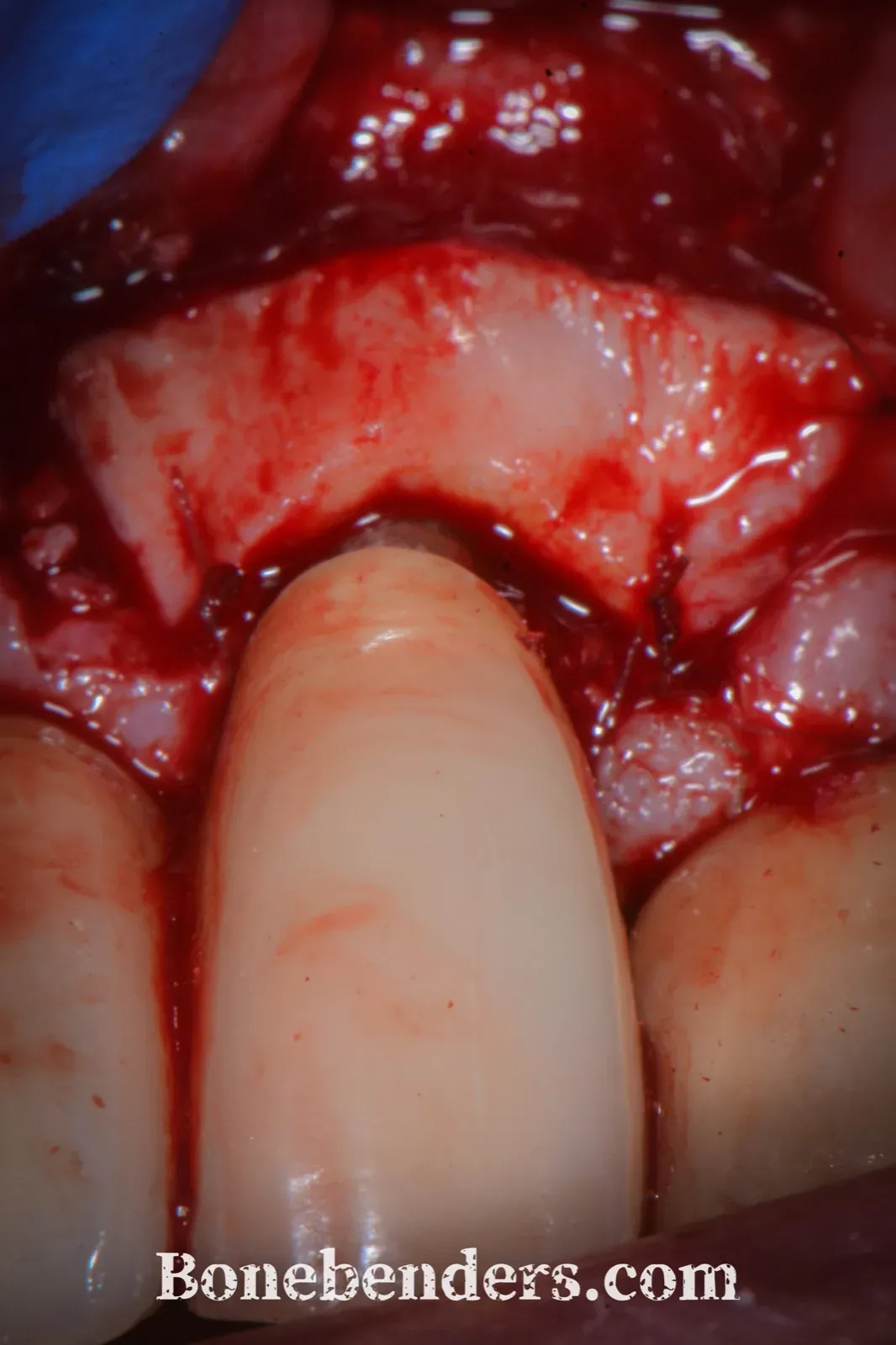 Innesto di connettivo prelevato dal palato posizionato sopra la superficie levigata e lo xenoinnesto, fissato con suture