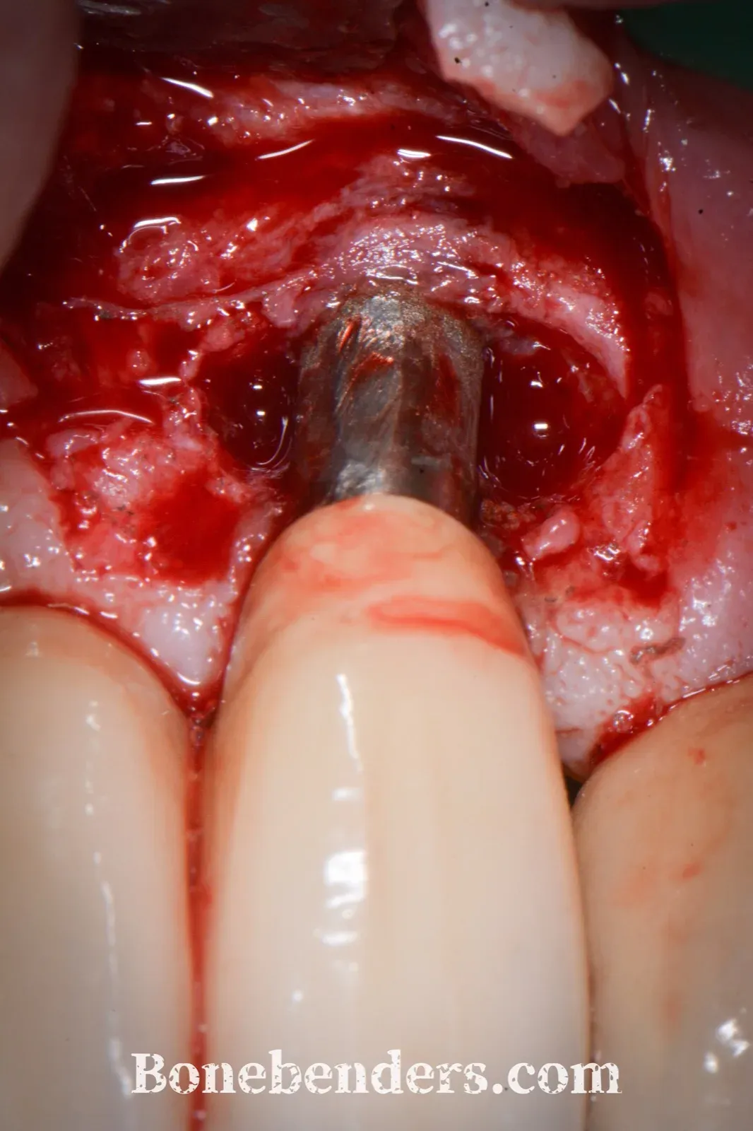 La superficie esposta dopo implantoplastica con strumenti rotanti: le spire sono state eliminate e la superficie è liscia