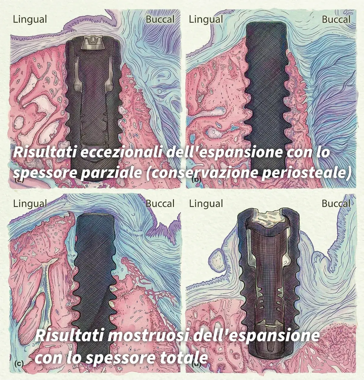 Confronto tra espansione crestale con lembo a spessore parziale e a spessore totale