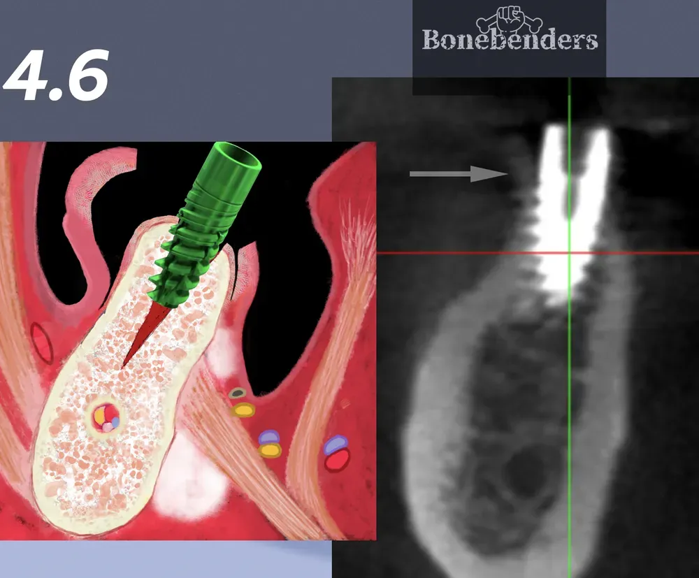 Illustrazione di un espansore inserito nell