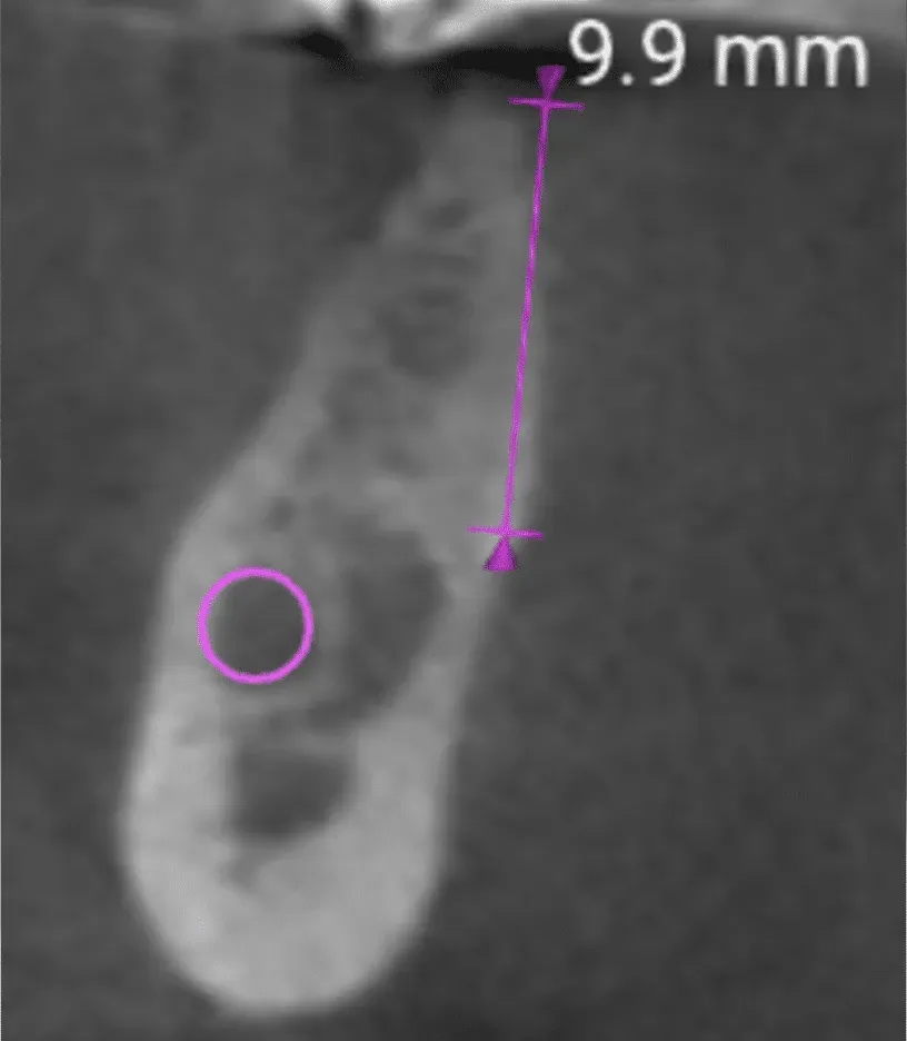 Poco osso per l’impianto? Difficile che sia veramente così