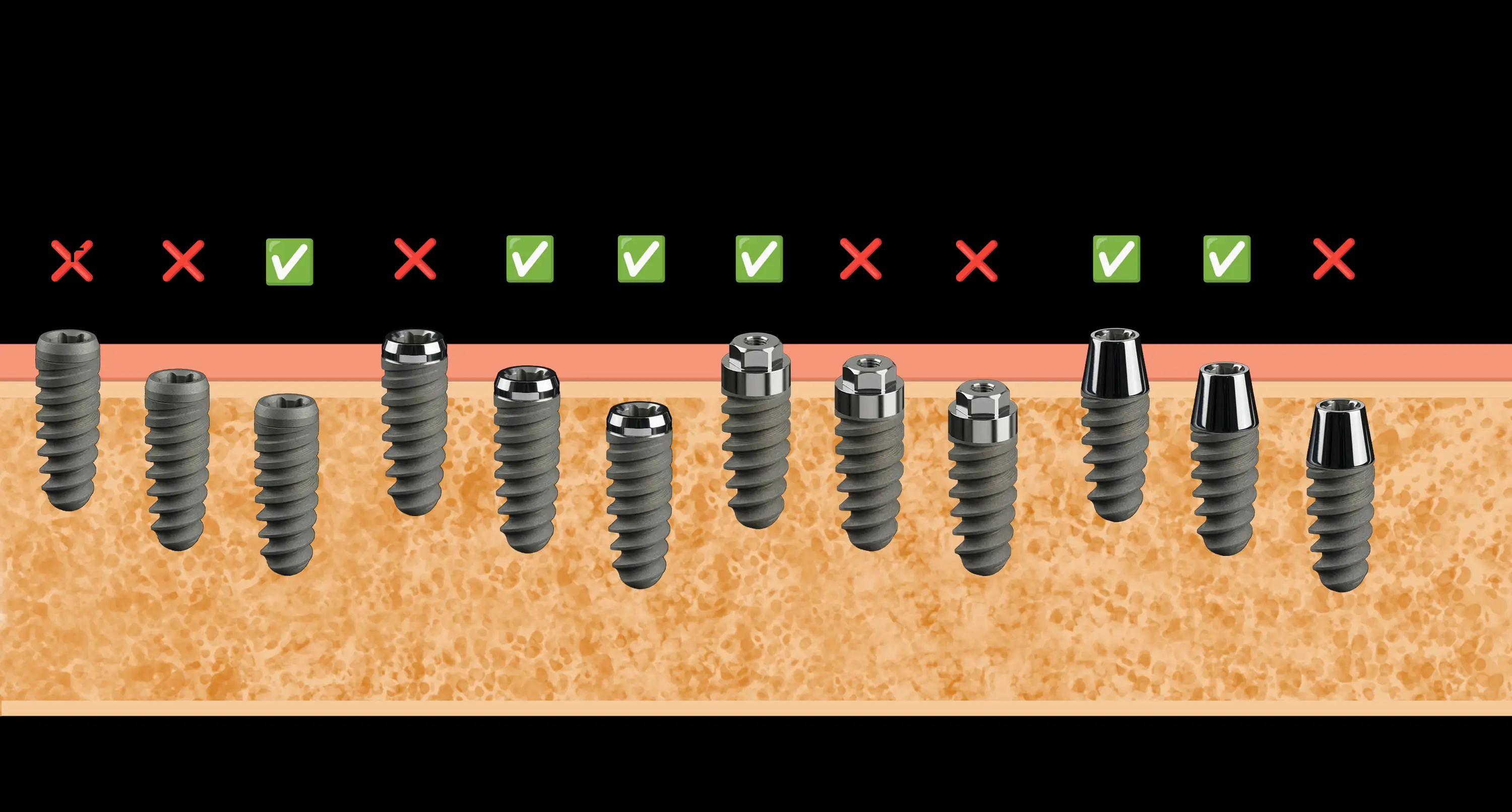 Diversi impianti dentali con connessioni diverse posizionati a profondità corrette e scorrette nella mucosa e nell'osso