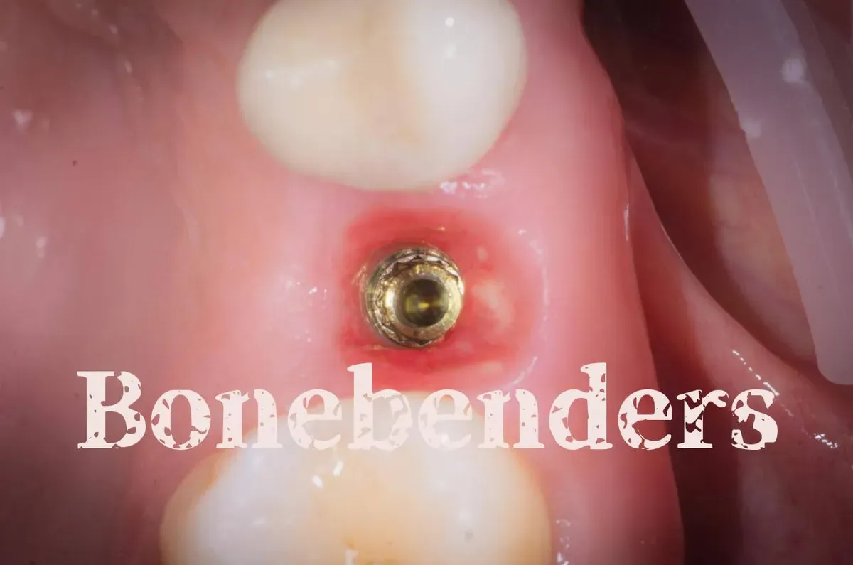 Quali sono i vantaggi dei Bonebenders sui Bonedrillers?