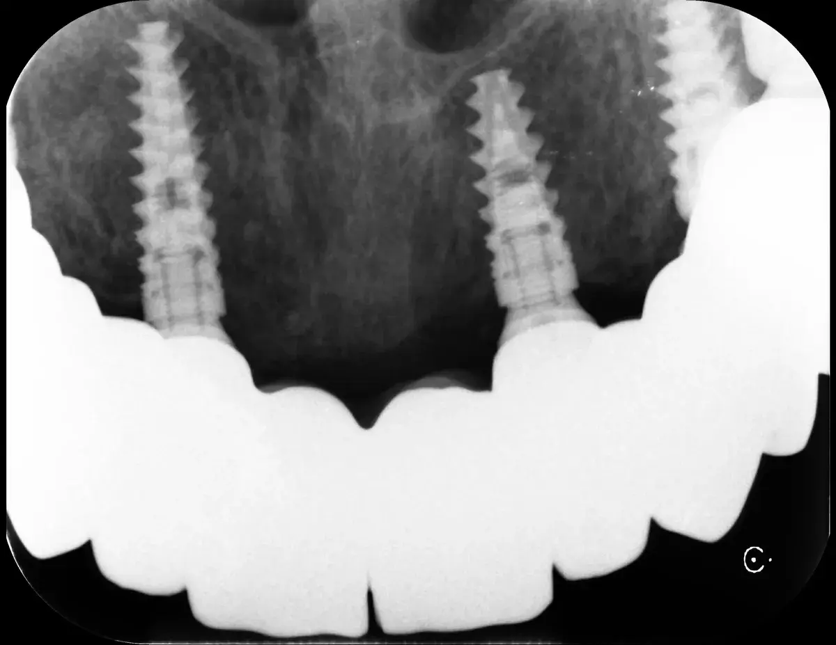 Quanto Costa Davvero un Impianto Dentale?