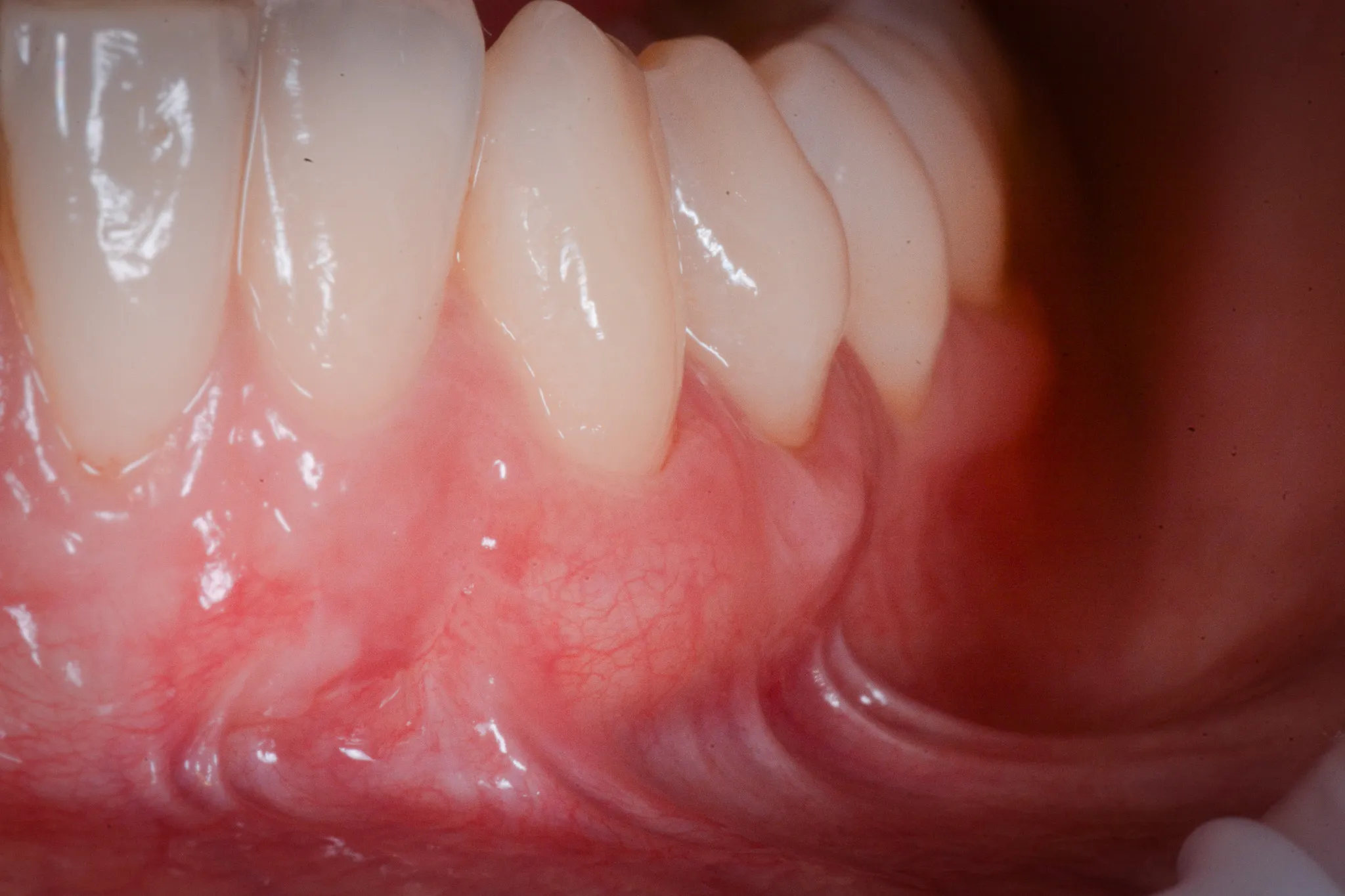 Risultato post-operatorio — visione frontale della copertura radicolare