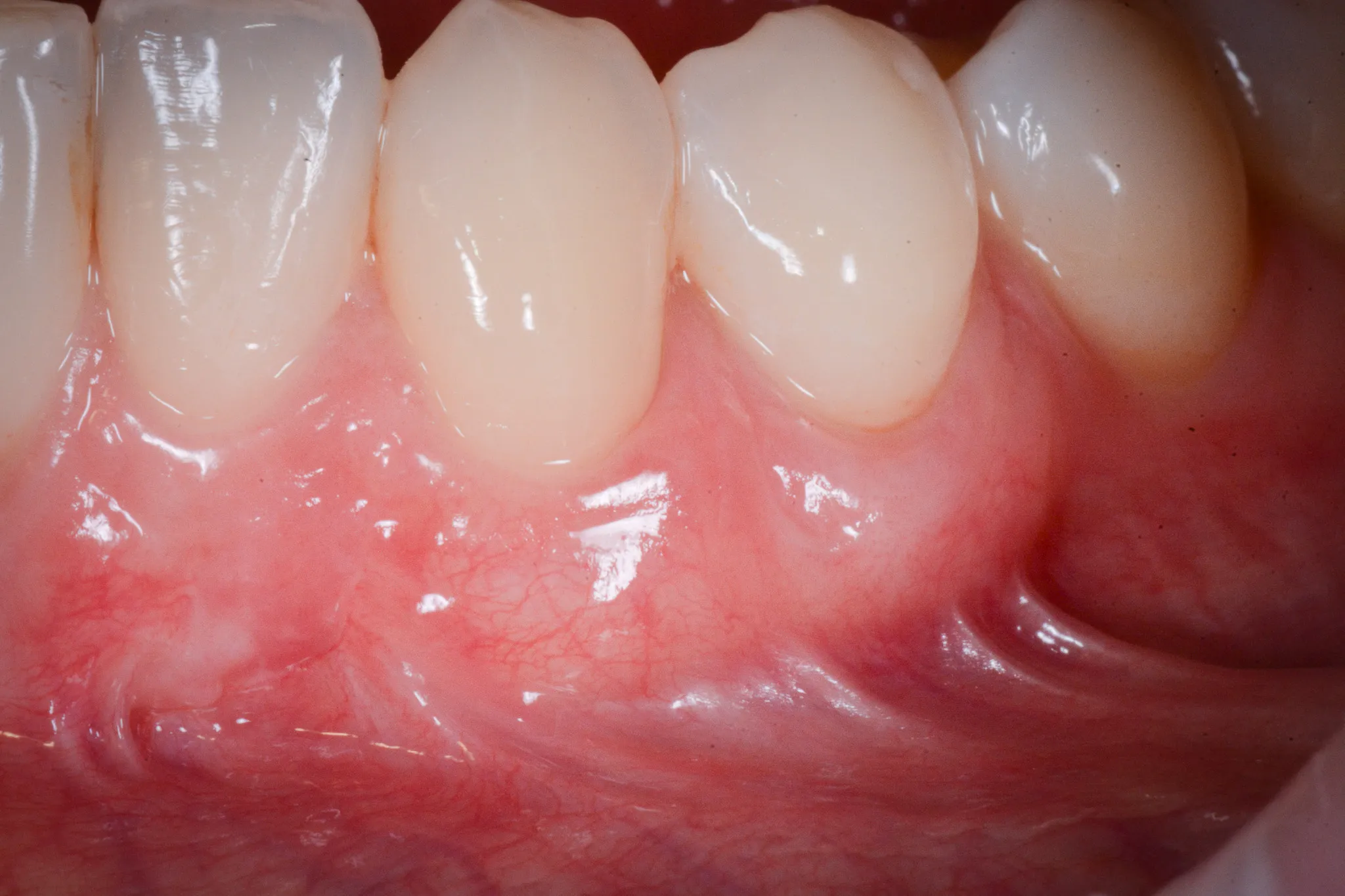 Risultato post-operatorio — visione laterale della copertura radicolare