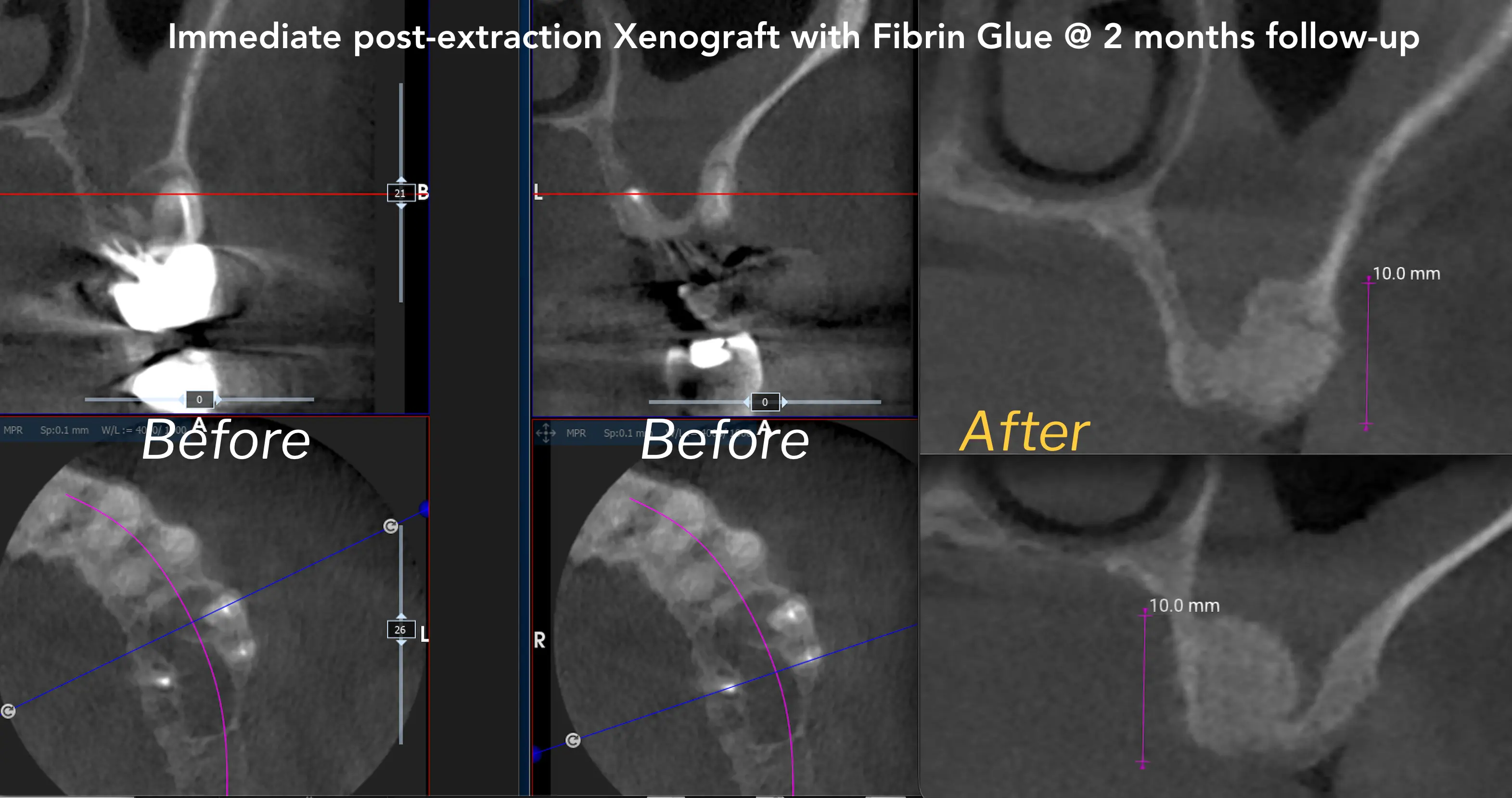 CBCT di rialzo di seno crestale post-estrattivo con xenoinnesto eterologo