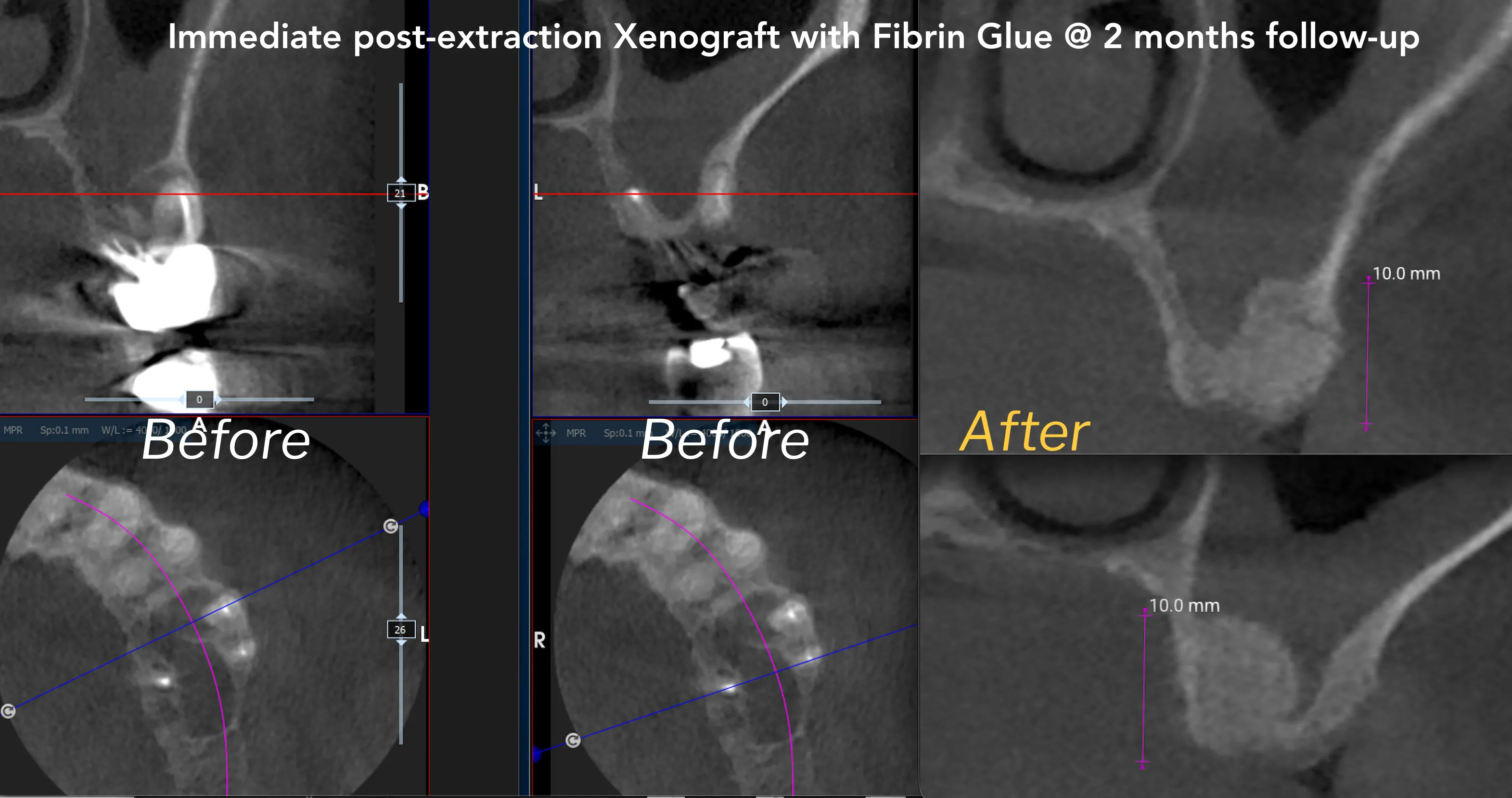 CBCT di rialzo di seno crestale post-estrattivo con xenoinnesto eterologo