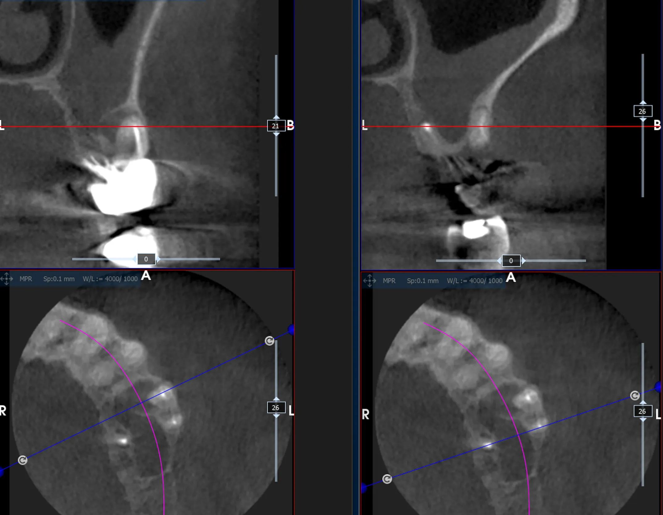 Sezioni CBCT pre-operatorie dell'elemento 2.6 fratturato con struttura ossea insufficiente per l'inserimento di un impianto immediato