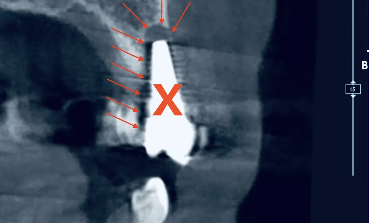 CBCT di un impianto dentale fallito con perdita ossea peri-implantare