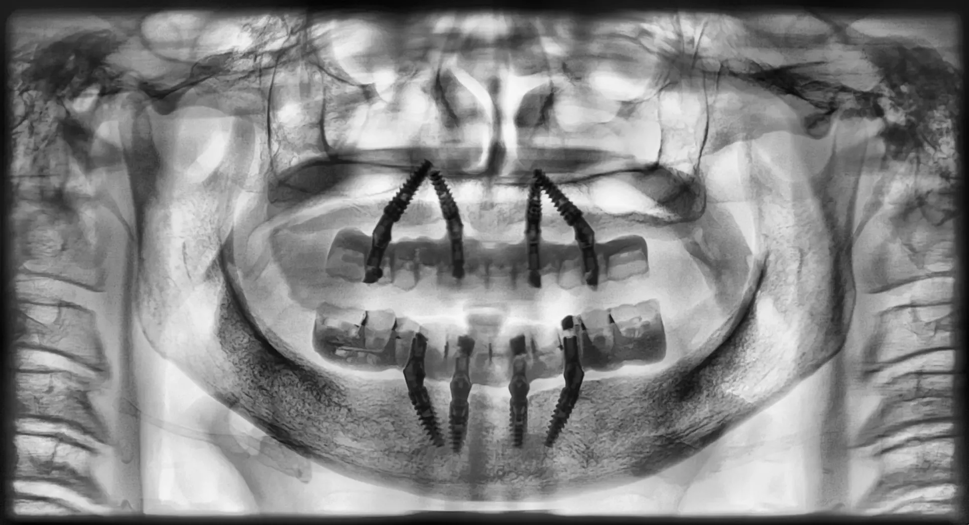 Panoramica a contrasto invertito a sei mesi con quattro impianti per arcata e i distali inclinati sotto due protesi fisse