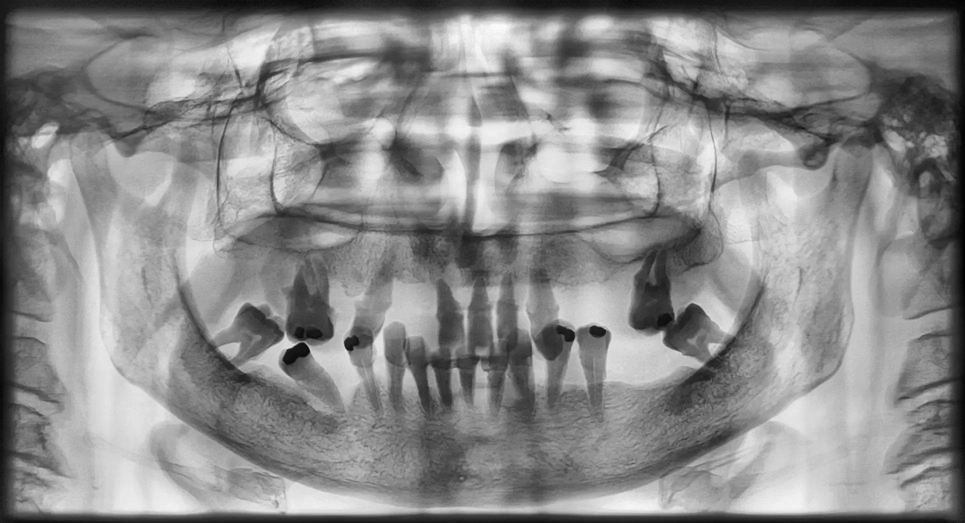Panoramica pre-operatoria a contrasto invertito con dentatura residua compromessa in entrambe le arcate