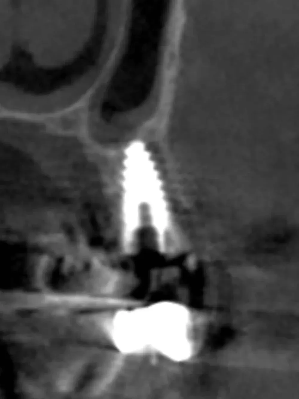 Immagine in bianco e nero che mostra un impianto dentale in una cavità orale.