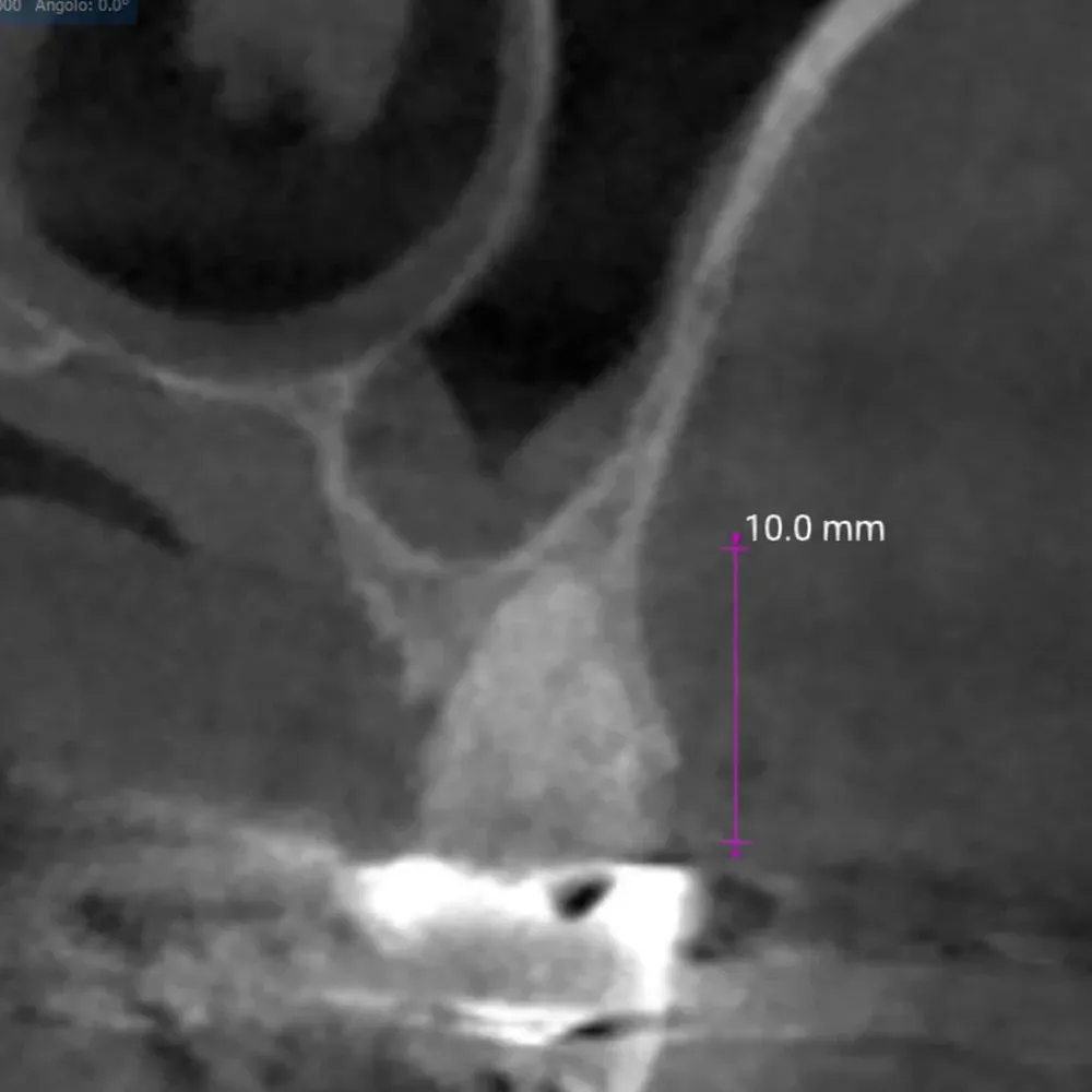 CBCT di elemento dentario 2.5 affetto da carie e tasca parodontale acuta